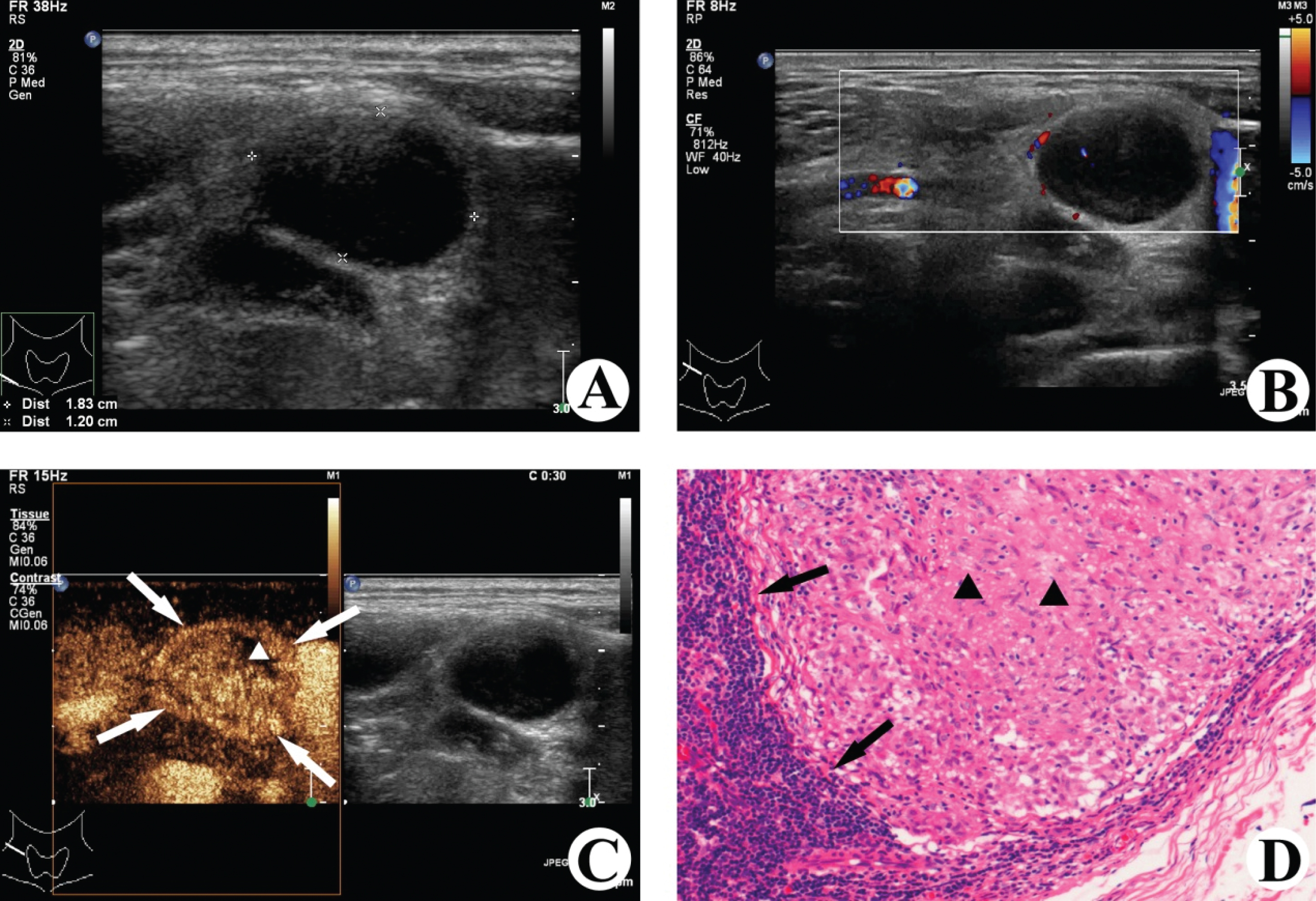 Images of a 35-years-old woman with tuberculosis in the right cervical lymph node. (A) Gray-scale ultrasound shows the hypoechoic enlarged lymph nodes with clear boundary, and the lymph node hilum is absent. (B) Color Doppler ultrasound detects few color signals of blood flow in and around the lymph node lesion. (C) CEUS image shows internal heterogeneous enhancement (▵ non-enhancing area) and peripheral rim-like enhancement (⟶). (D) The lymph node was surgically removed, and caseous necrosis (▴) and local granulation tissue hyperplasia (⟶) in the lymph node were observed under the microscope (HE×200).