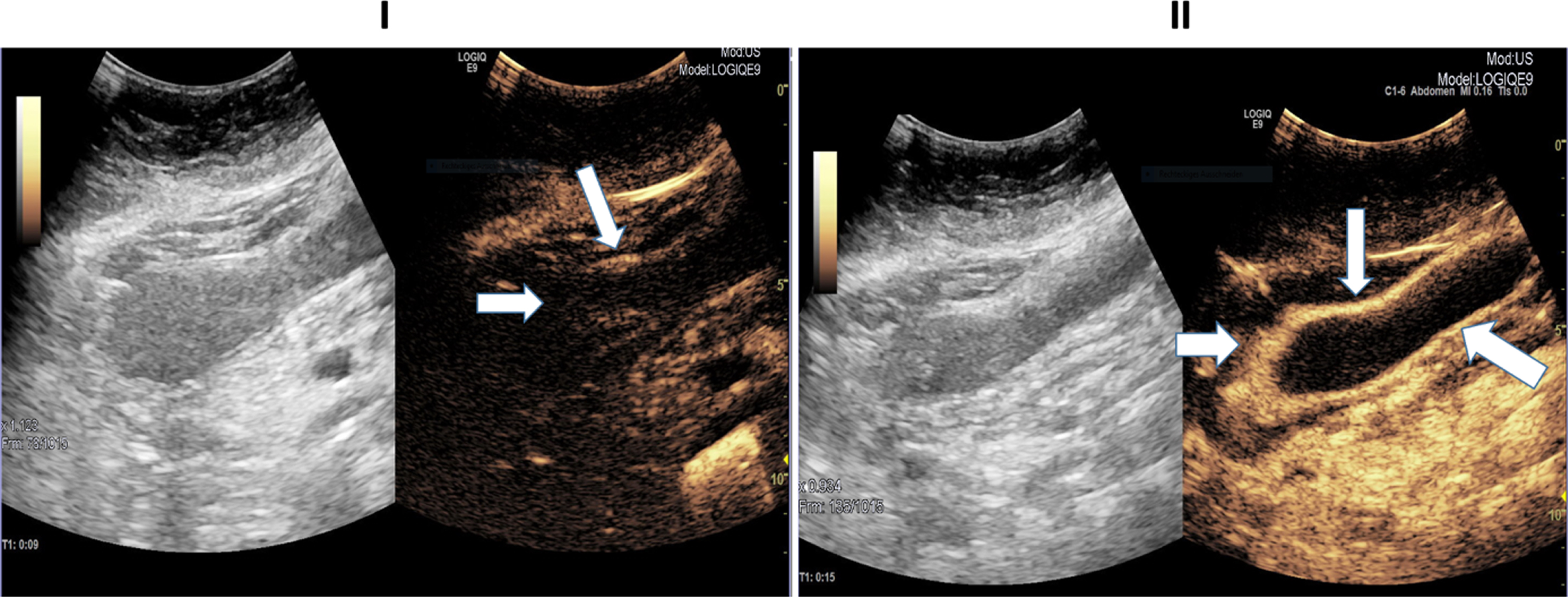 Ultrasound images of a 45-year-old patient with severe COVID-19 disease. I: B Mode ultrasound showing intestinal wall thickening; CEUS image showing mild arterial enhancement 9 seconds after SonoVue application (white arrows). II: CEUS image showing early and strong arterial hyperenhancement of the intestinal wall (white arrow) 15 seconds after SonoVue application.