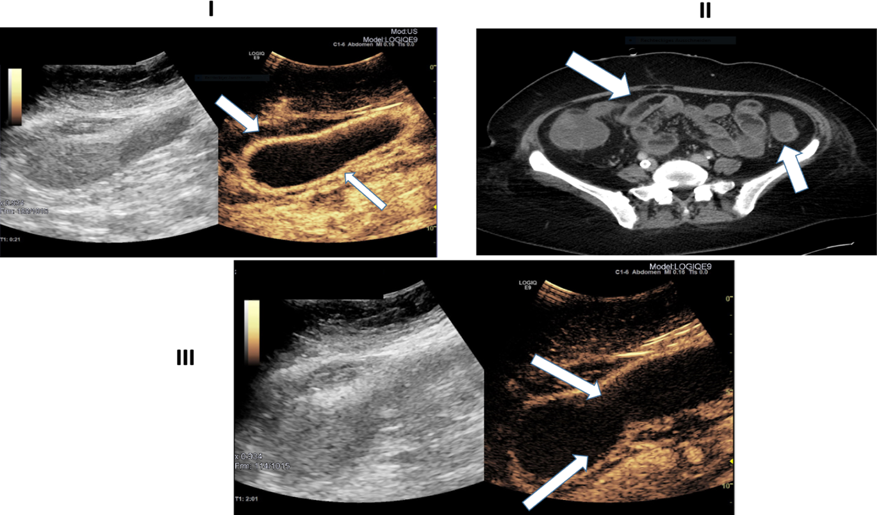 Ultrasound images of a 45-year-old patient with severe COVID-19 disease. I: B-Mode ultrasound showing intestinal wall thickening. CEUS image manifesting early and strong arterial hyperenhancement of the intestinal wall (white arrows) 21 seconds after SonoVue application. II: Computertomography (CT) image depicting bowel wall edema and contrast enhancement of the bowel wall (white arrows). III: CEUS imaging expressing transmural penetration of microbubbles (white arrows).