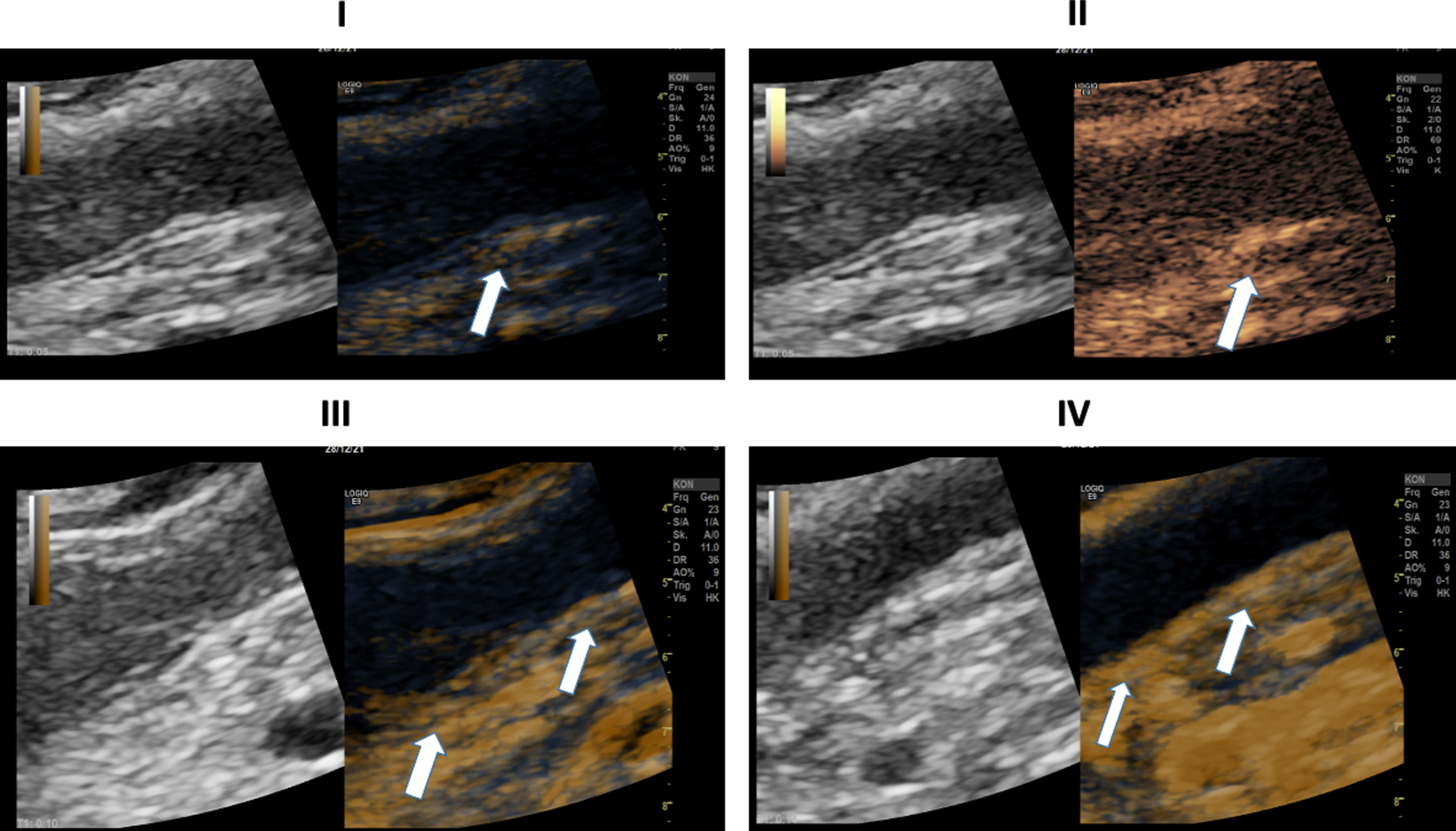 Ultrasound images of a 45-years-old patient with a severe COVID-19 Infection. I: CEUS image showing early, pronounced and especially segmental, transmural arterial hyperenhancement of the intestinal wall (white arrows) 5 seconds after SonoVue application. II: CEUS image showing early, strong, and especially segmental, transmural arterial hyperenhancement of the intestinal wall (white arrows) 5 seconds after SonoVue application. III: CEUS Image shows long-distance, marked contrast uptake across all intestinal wall layers 10 seconds after SonoVue application. IV: CEUS Image shows long-distance, distinct contrast uptake across all intestinal wall layers 14 seconds after SonoVue application.