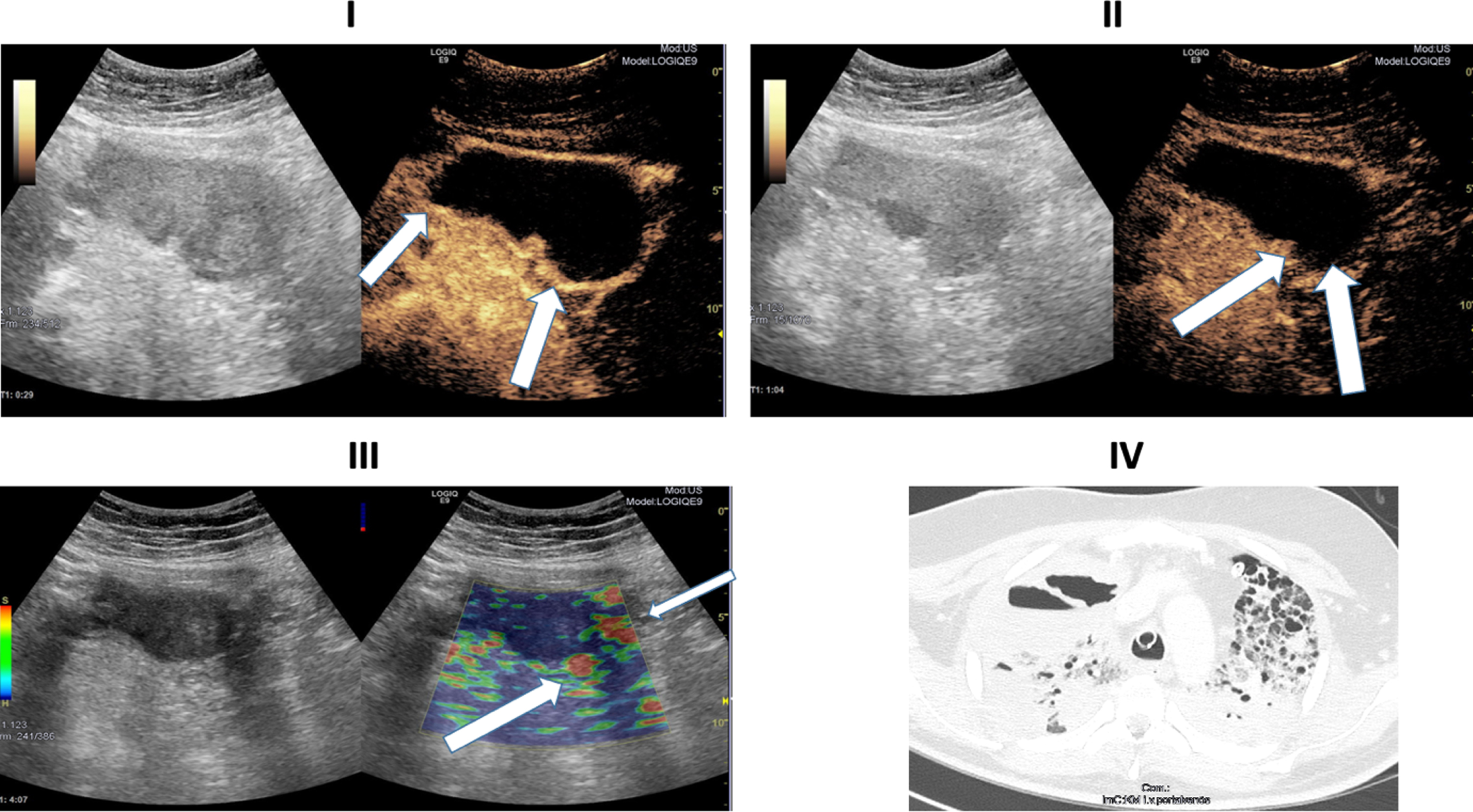Ultrasound images of a 30-years old-patient with a severe COVID-19 Infection. I: B-Mode ultrasound showing intestinal wall thickening. CEUS image showing early and strong arterial hyperenhancement of the intestinal wall (white arrows) 29 seconds after SonoVue application. II: CEUS imaging showing transmural penetration of microbubbles (white arrows). III: Soft tissue edema as a correlate of acute inflammation by strain elastography (white arrows). IV: CT of the lung. 39 days after COVID-19 diagnosis.