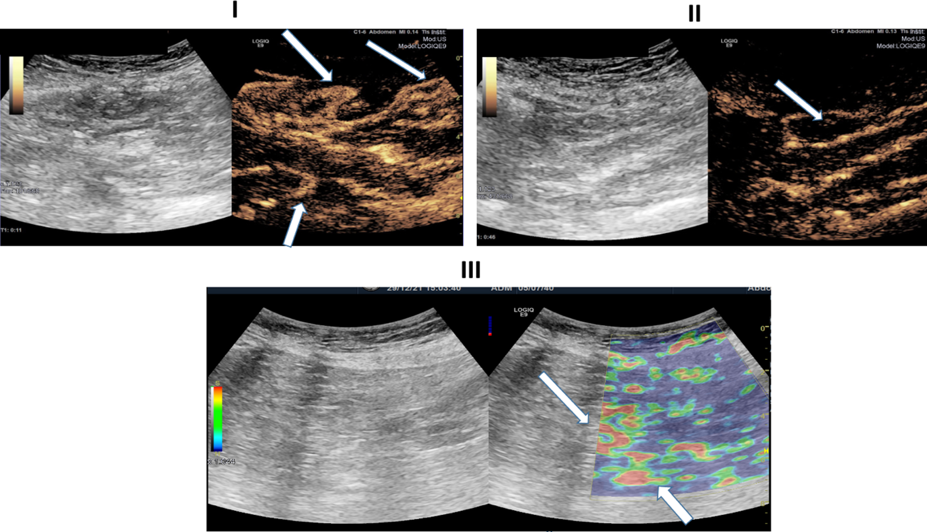 Ultrasound images of a 81-years-old patient with severe COVID-19 disease. I: B-Mode ultrasound showing intestinal wall thickening. CEUS image showing early and pronounced arterial hyperenhancement of the intestinal wall (white arrows) 11 seconds after SonoVue application. II: CEUS imaging depiciting translocation of microbubbles (white arrows) into the intestinal lumen. III: Soft tissue edema as a correlate of acute inflammation diagnosed by strain elastography (white arrows).