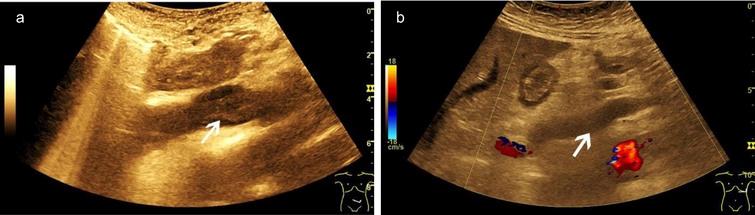 A case of abdominal venous thrombosis happened during severe COVID-19 infection. B mode ultrasound (BMUS) scan shows hypoechoic thrombosis of the inferior vena cava (a, arrow). Color-coded Doppler ultrasound (CCDS) shows flow separation into the lumen of the portal vein (b, arrow).