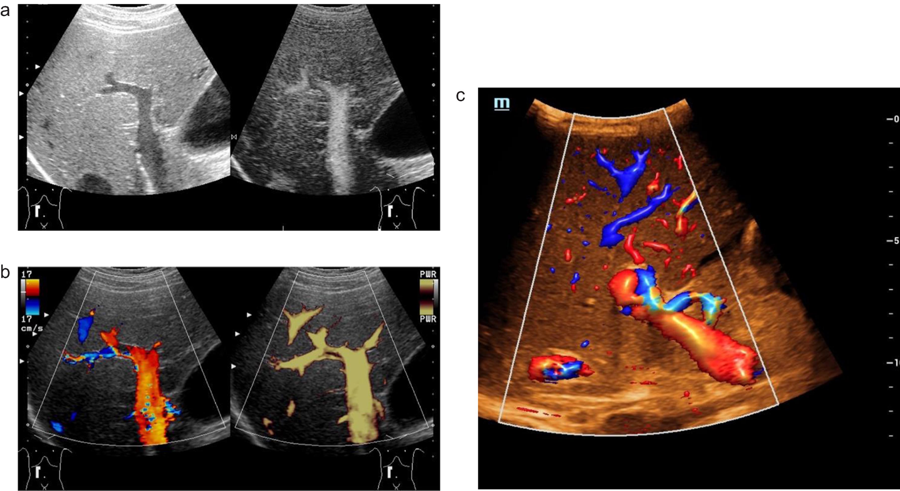 Optimizing ultrasound examinations of the portal vein. B mode ultrasound (a, left) and B flow scan shows blood flow of the portal vein (a, right). Color-coded Doppler ultrasound (CCDS) (b, left) and Power Doppler show flow in the lumen of the portal vein (b, right). Hemodynamic assessment of the hepatic artery with CCDS including high resolution (HR) and Glazing Flow (c).