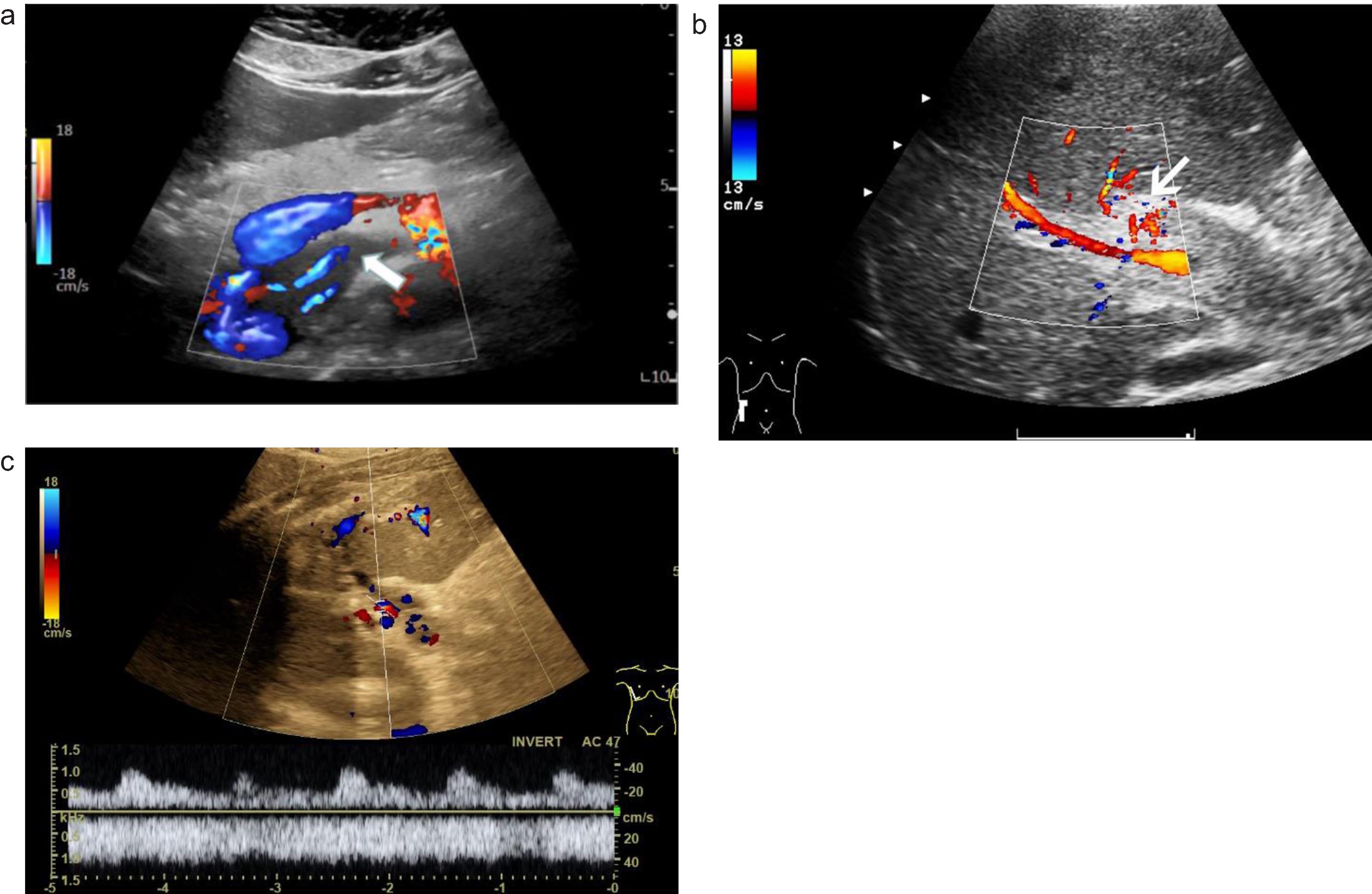 A case of abdominal venous thrombosis happened after severe COVID-19 infection. Color-coded Doppler shows hypoechoic thrombosis of the superior mesenteric vein (a, arrow). Color-coded Doppler ultrasound (CCDS) shows flow separation into the lumen of the portal vein after thrombosis (b, arrow). Color-coded Doppler (CCDS) flow changes after thrombosis of the portal vein (c).