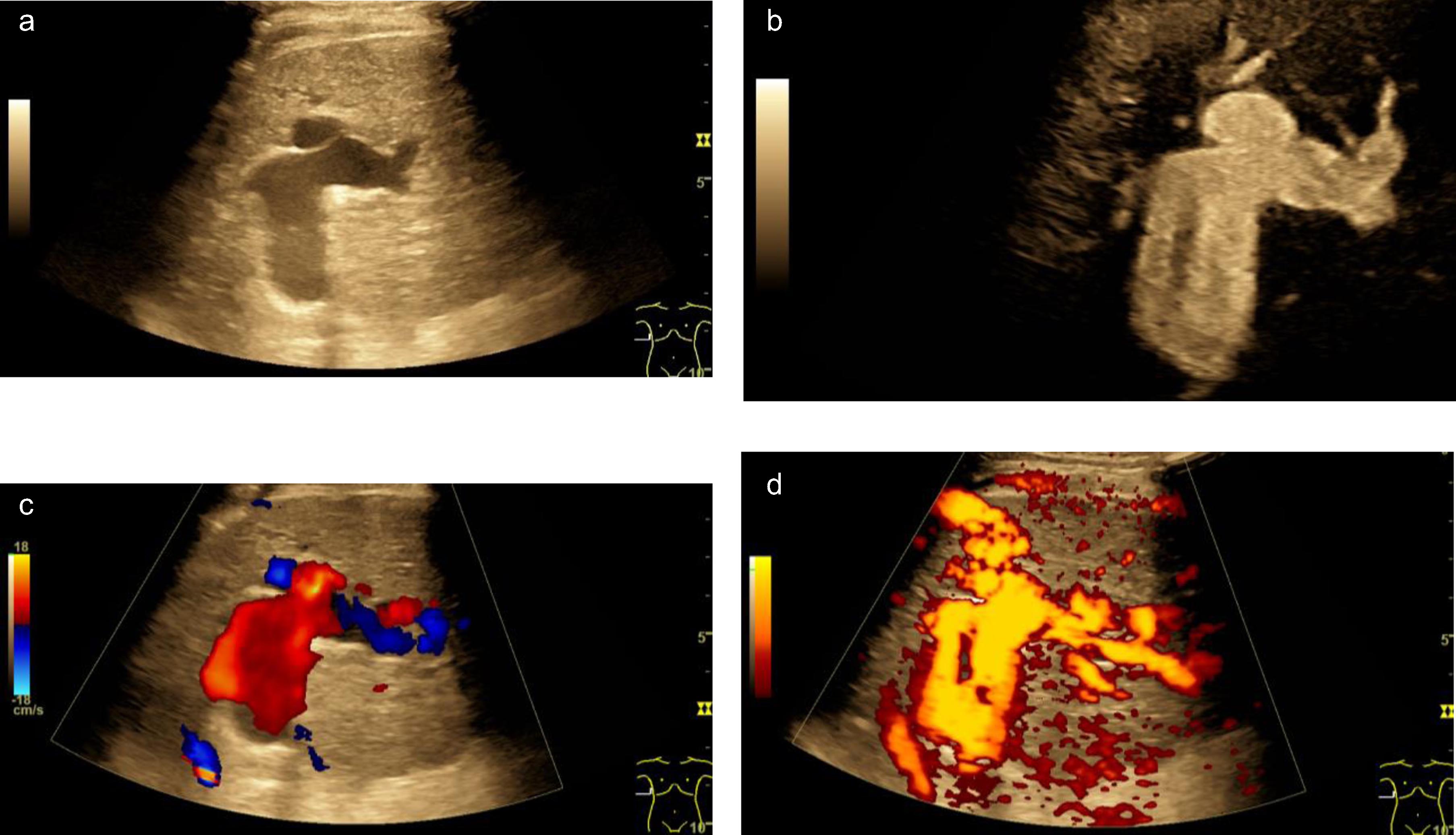 Aneurysm of the portal vein during severe COVID-19 infection. B mode ultrasound scan (a), B-flow (b), color-coded Doppler ultrasound (CCDS, c) and power Doppler (d) show enlargement of vascular lumen with blood flow.