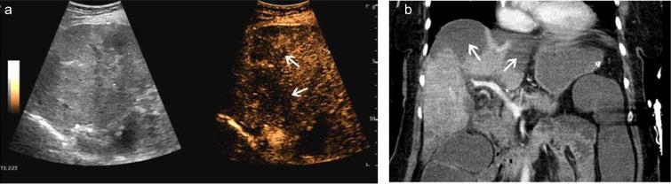 A case of scan Covid 19 infection. After thrombosis of the portal vein and liver veins, CEUS showed scattered multiple hypoenhanced lesions with necrosis (a, arrow). CT showed the same low-density lesions in the liver (b, arrow).