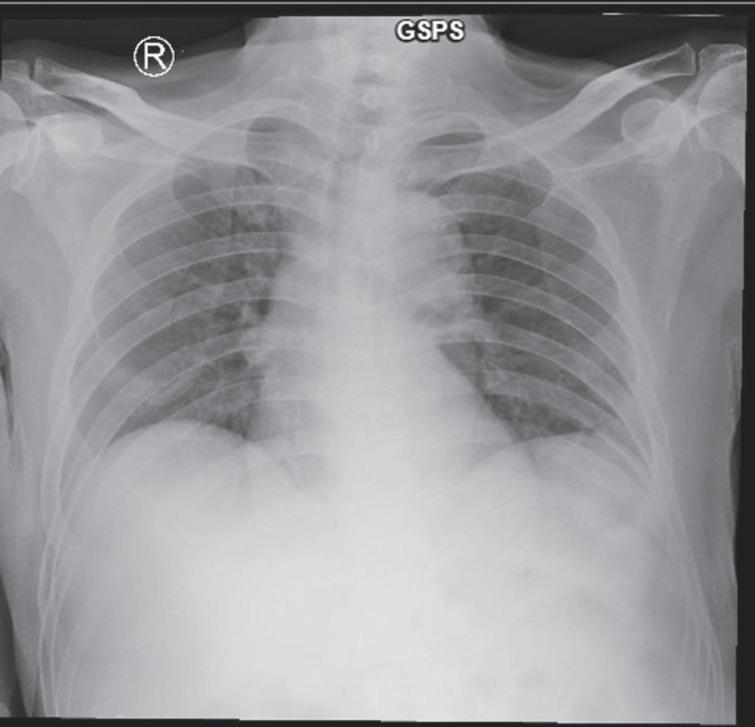 Chest radiography revealed a lung infiltration in the lower right field for Case 1.