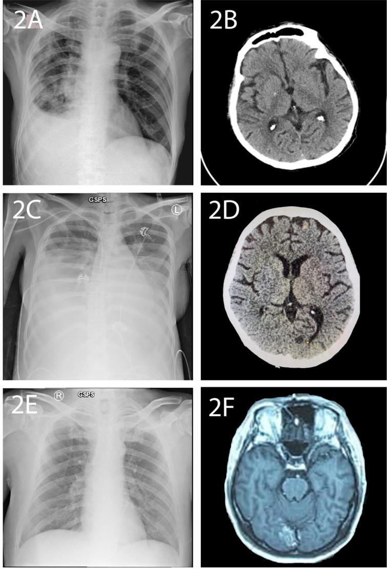 Chest radiography and head CT-scan of patients. (A) Chest radiography Case 2, (B) head CT-scan Case 2, (C) Chest radiography Case 3, (D) head CT-scan Case 3, (E) Chest radiography Case 4, (F) head CT-scan Case 4.