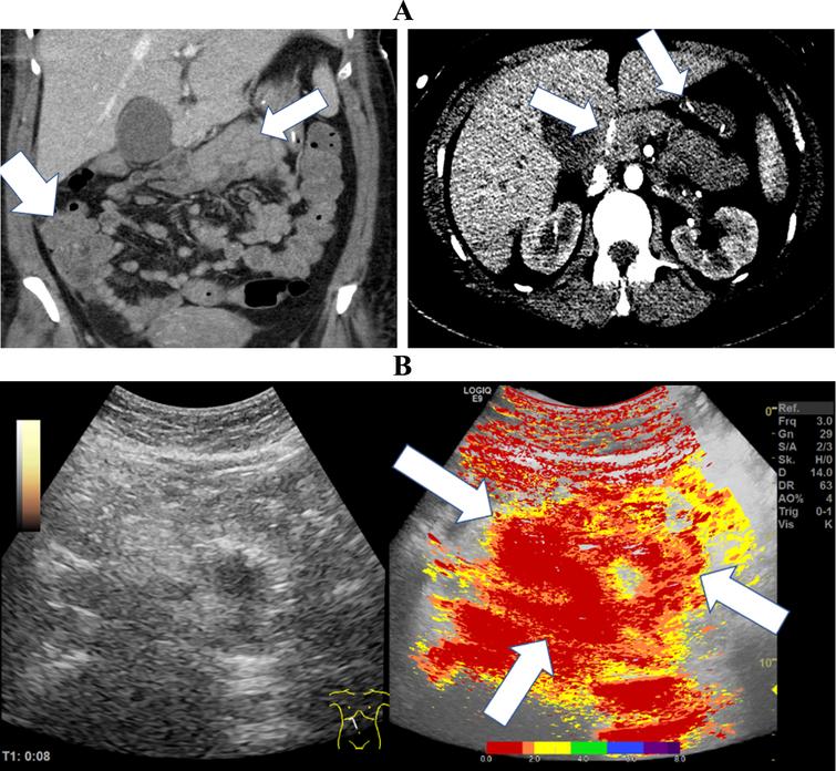 CT images of a 37-year-old patient with severe COVID-19 ARDS. A: The CT images documented hyperperfused small bowel areas (white arrows) and an early contrast enhancement in the mesenteric vessels (white arrows). B: The broad red coloration in the parametric analysis indicated early transmural enhancement (white arrows) of the small bowel sections.
