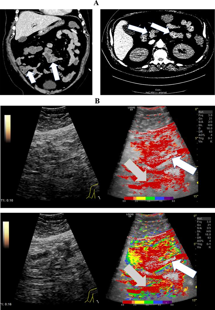 CT images of a 59-year-old patient. A: CT image demonstrated simultaneous hyper- and hypo perfusion of the small bowel segments. B: In the parametric analysis of contrast ultrasound the image is congruent with the CT (Fig. 3). Segmental areas of the small bowel are hyper perfused and other areas are hypo perfused.The parametric images visualized simultaneous hypo- (white arrows) and hyper perfusion (gray arrows) 10 and 16 seconds after contrast administration.