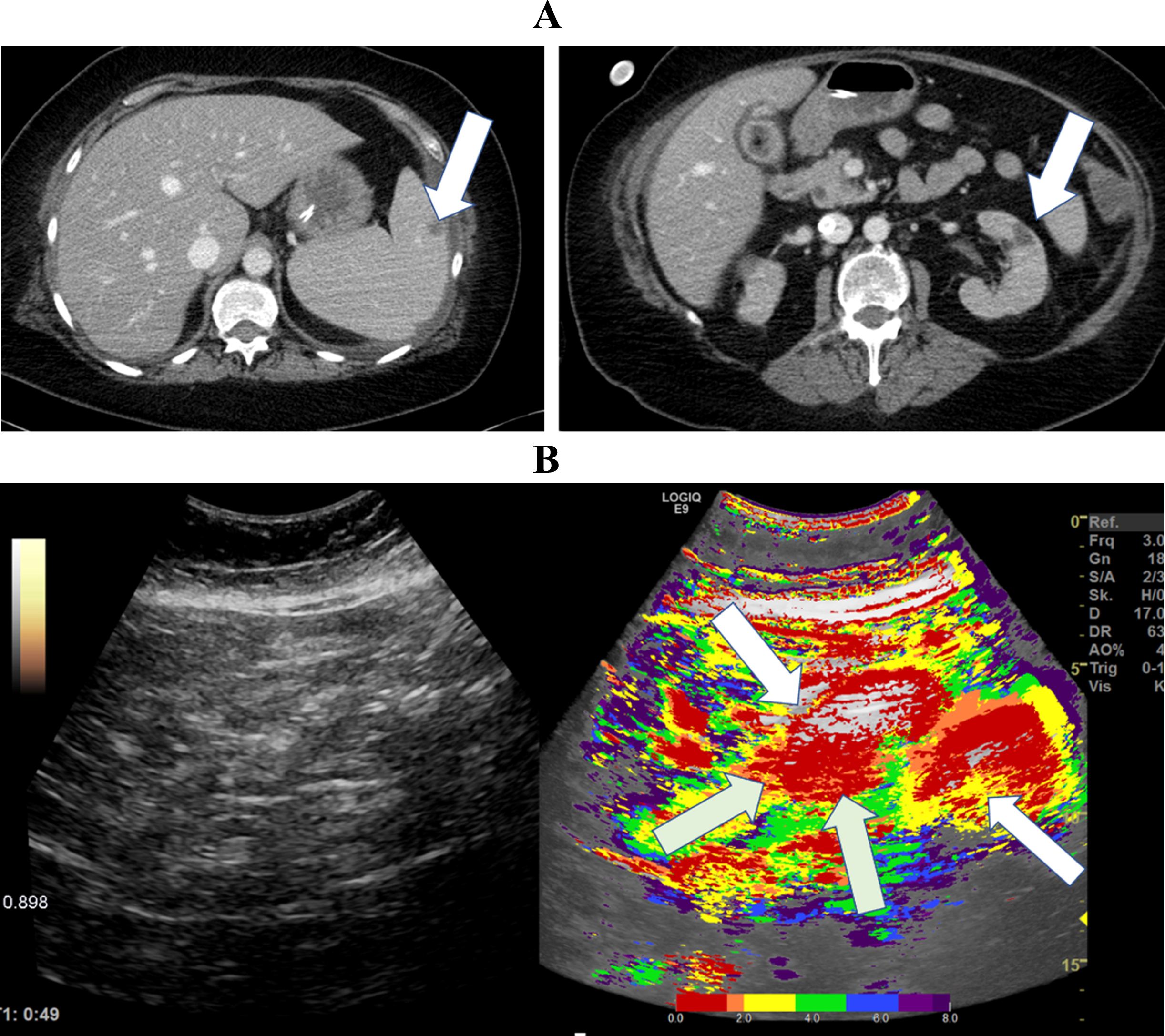 A: CT images from a 50-year-old patient with severe COVID-19 ARDS. CT images document micro emboli in the kidney and spleen (white arrows). B: Parametric Image of a 50-year-old patient with severe COVID-19 disease.The parametric images visualized simultaneous hypo- (yellow areas, white arrows) and hyper perfusion (gray arrows) of the small intestine 49 seconds after contrast administration.