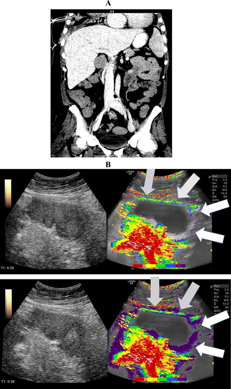 A: CT Image of a 30-year-old patient with severe COVID-19 ARDS showing simultaneous segmental early and delayed contrast enhancement of the small intestine. B: Parametric Images of a 30-year-old patient with severe COVID-19 disease.The parametric images visualized simultaneous early- (white arrows) and delayed (gray arrows) segmental perfusion of the small intestine 39 seconds after contrast administration.