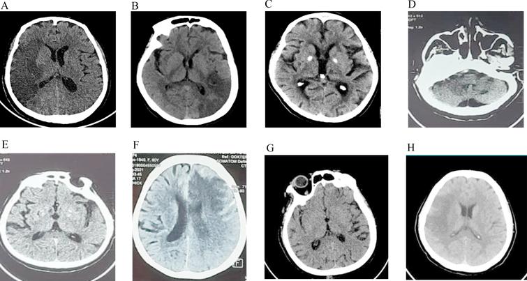 Representative image of the CT-scan infarct extension region. A: frontal, parietal, temporal, occipital; B: parietal; C: thalamus; D: pons and cerebellum; E: basal ganglia; F: frontal, temporal, parietal: G: oksipital, temporal; H: frontal, parietal.
