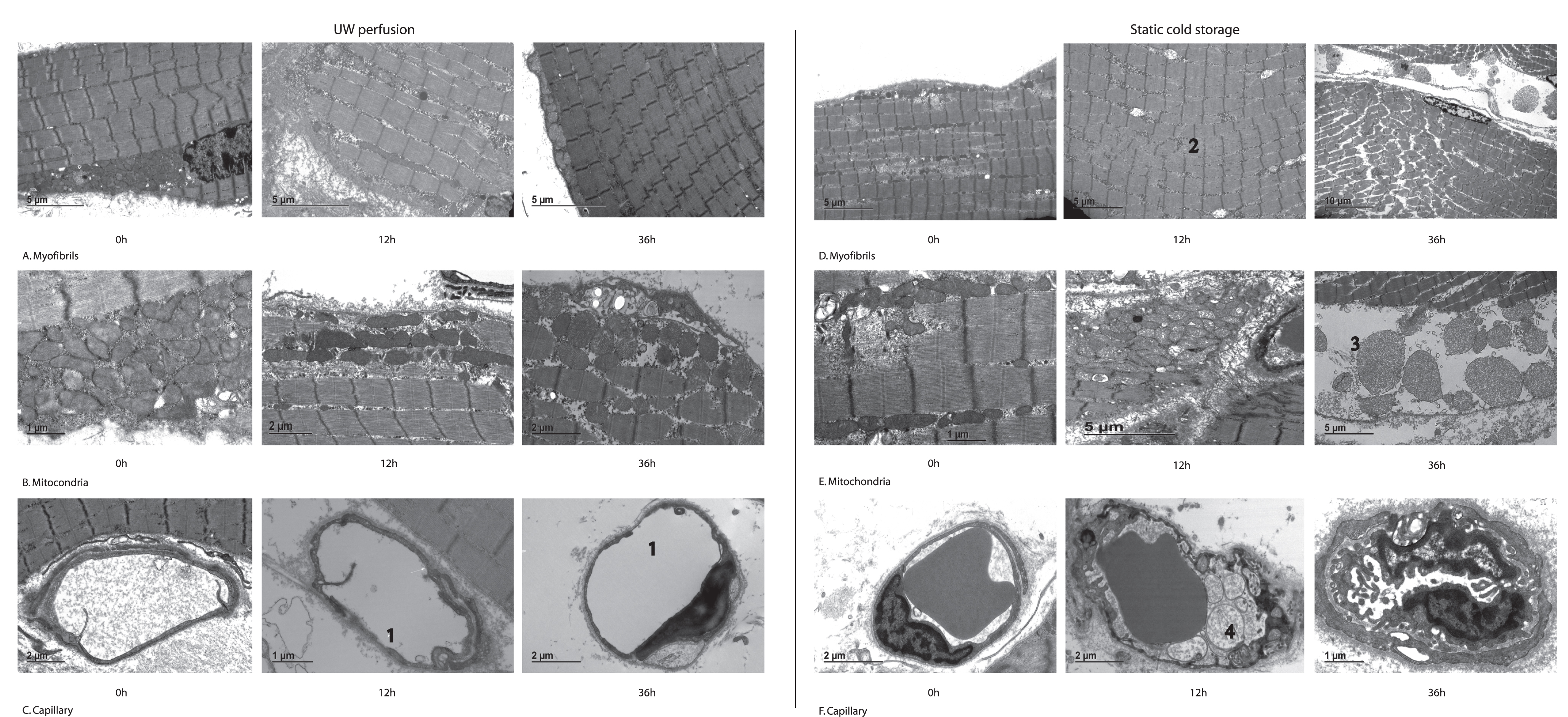 Representative electron microscopy images of muscle biopsies taken during extracorporeal perfusion and static cold storage throughout the preservation period. Left top row: myofibrillar arrangement during ECP showing preserved architecture with only minor Z-band changes. Left middle row: mitochondria during ECP showing mild swelling over time, but no degeneration. Left bottom row: capillaries during ECP with focal thinning at 12 h and 36 h of preservation (1). Right top row: myofibrillar arrangement during SCS showing Z-band changes at 12 h (2) and severe distortion of arrangement at 36 h of preservation. Right middle row: mitochondria during SCS showing swelling at 12 h and destruction at 36 h with rupture of membrane and leaking of contents (3). Right bottom row: capillaries during SCS with vacuoles and debris extending into the lumen (4) at 12 h, evolving into luminal obstruction at 36 h of preservation.