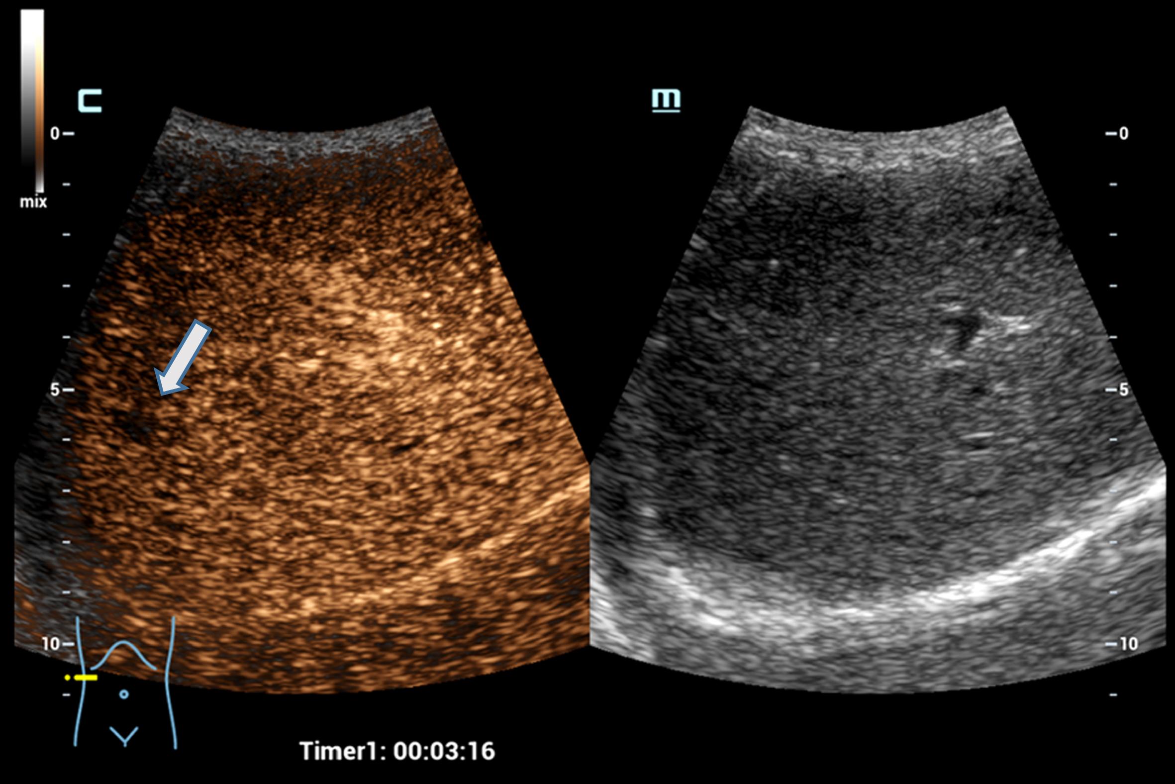 Case of a 76 years old patient with colorectal cancer. Detection of a small liver metastasis of the right liver lobe, less than 1 cm in diameter using the HiFR CEUS technology after bolus injection of 1.5 ml ultrasound contrast agent. Wash out of the non-cystic lesion, image after 3 minutes in the late venous phase (left side, arrow). The lesion is not visible on fundamental B-mode (right side).