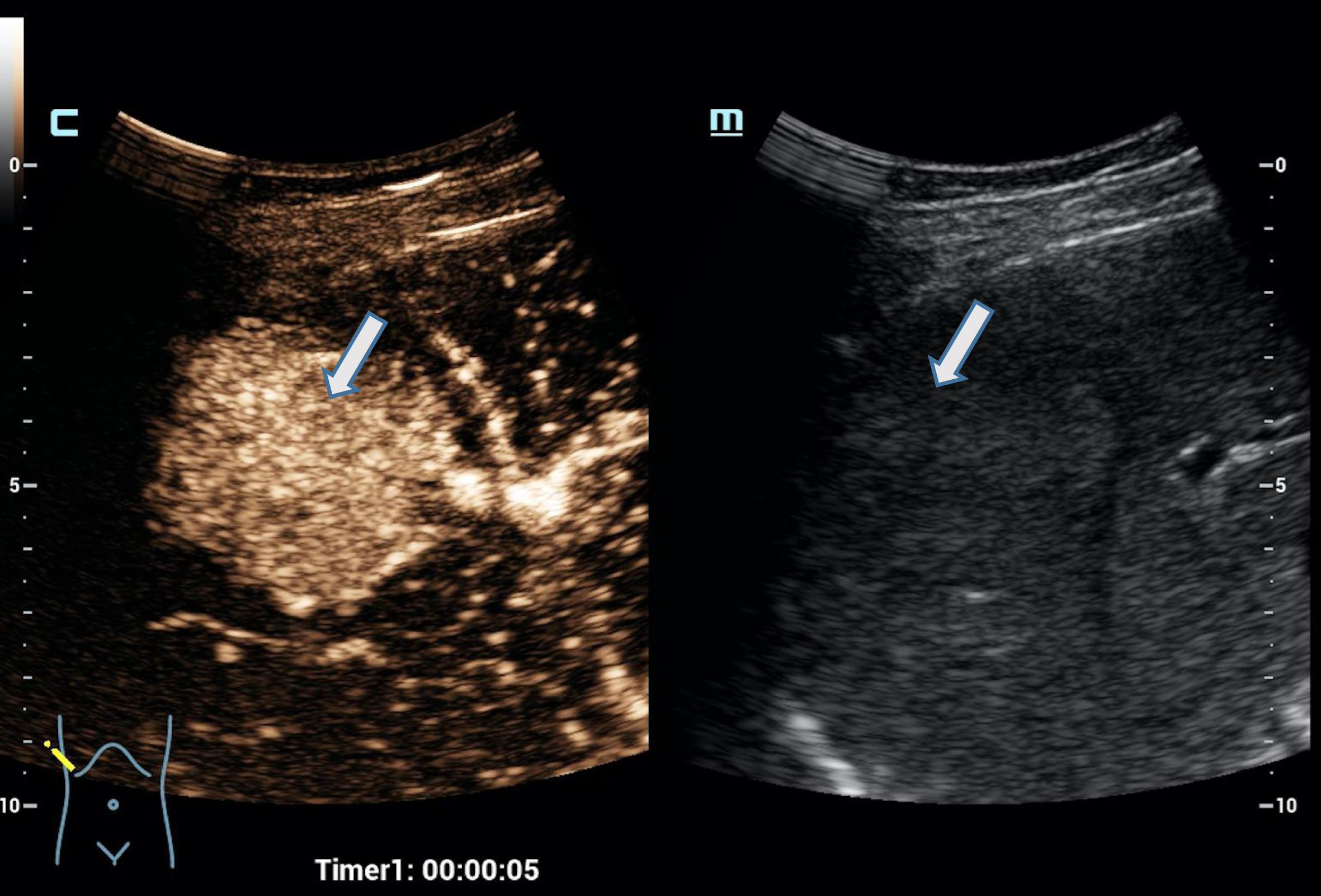 Case of a 34 years old female patient with focal nodular hyperplasia (FNH). Detection in the early arterial phase using the HiFR CEUS technology after bolus injection of 1.0 ml ultrasound contrast agent hyperenhancement from the center to the margin (arrow). Excellent visualization by HiFR CEUS. The lesion is difficult to detect on fundamental B-mode (right side).