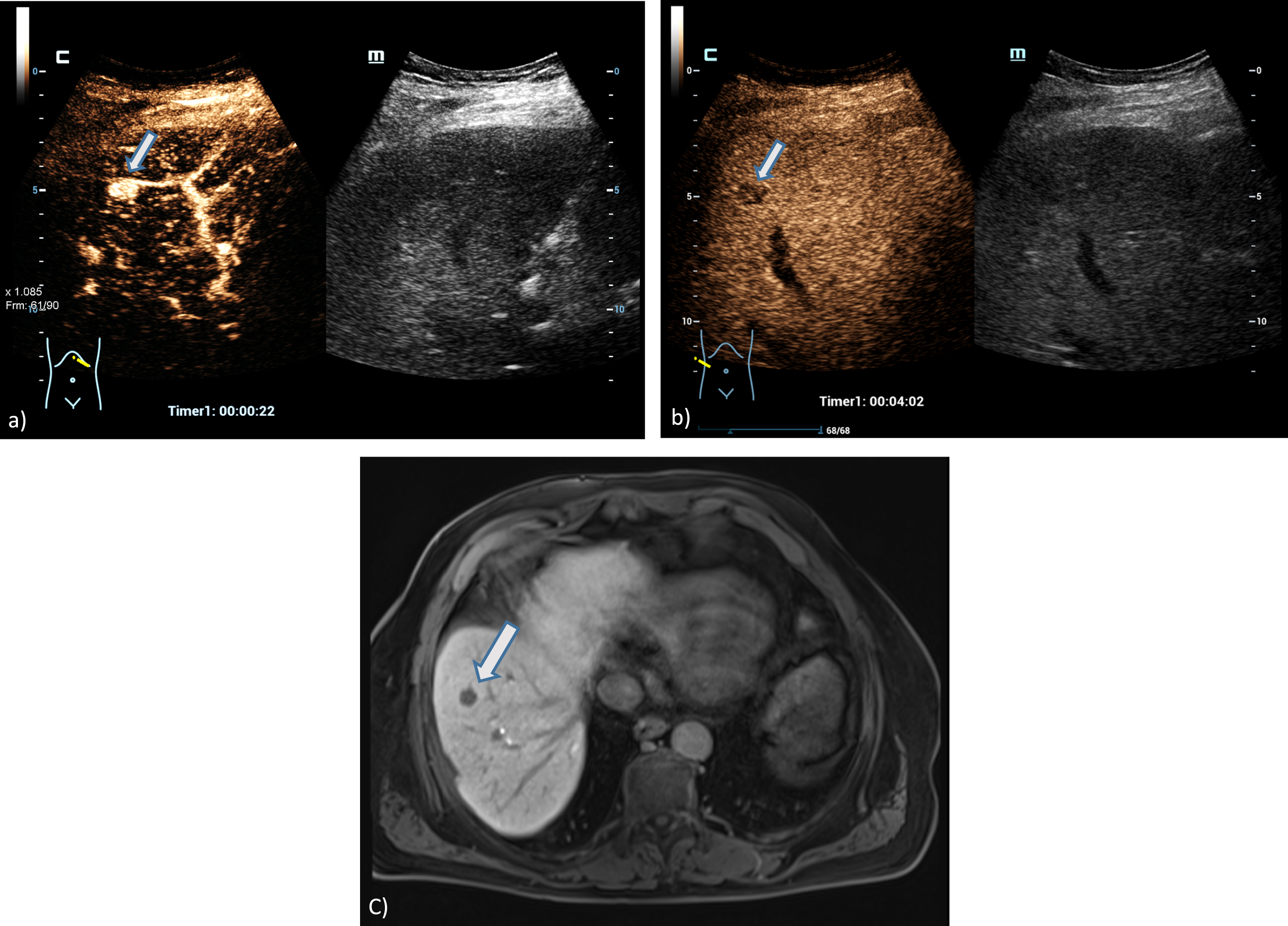 A 73 years old patient with a small lesion of a hepatocellular carcinoma. Detection of a small tumor lesion of the right liver lobe, at maximum 1 cm in diameter using the HiFR CEUS technology after bolus injection of 1.5 ml ultrasound contrast agent (left side, arrow). Clear detectable by HiFR CEUS with irregular arterial hypervascularization (a) and wash out after 4 minutes (b) and by MRI using liver specific contras agent (c). The lesion is not visible on fundamental B-mode (right side).