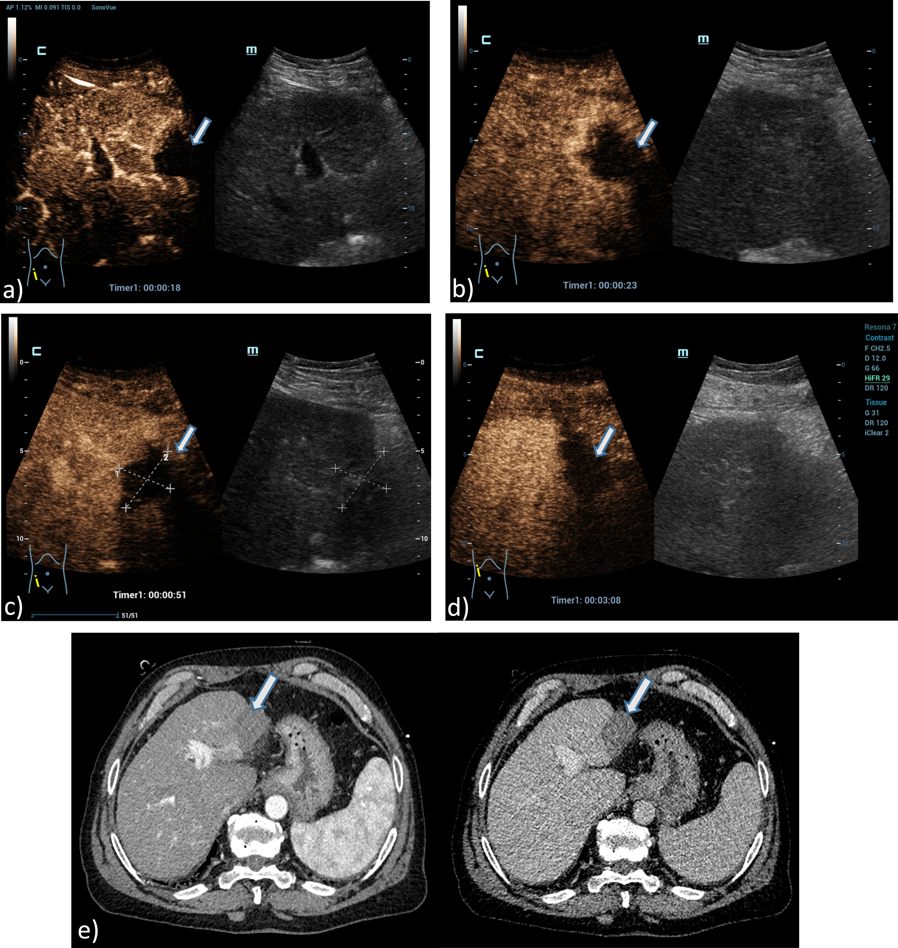 A 61 years old patient with post ablation defect after MWA. Detection of an avascular defect on the left liver lobe, at maximum 4 cm in diameter using the HiFR CEUS technology after bolus injection of 1.5 ml ultrasound contrast agent (left side, arrow). Clear detectable MWA defect by HiFR CEUS with central devascularization during early arterial phase (a), arterial phase (b), portal venous phase (c) and up to late phase after 3 minutes (d) in comparison to contrast enhanced CT scans (e) during arterial phase (left) and portal venous phase (right) as a vascular defect on the left liver lobe (arrows). The lesion is not clear visible on fundamental B-mode.