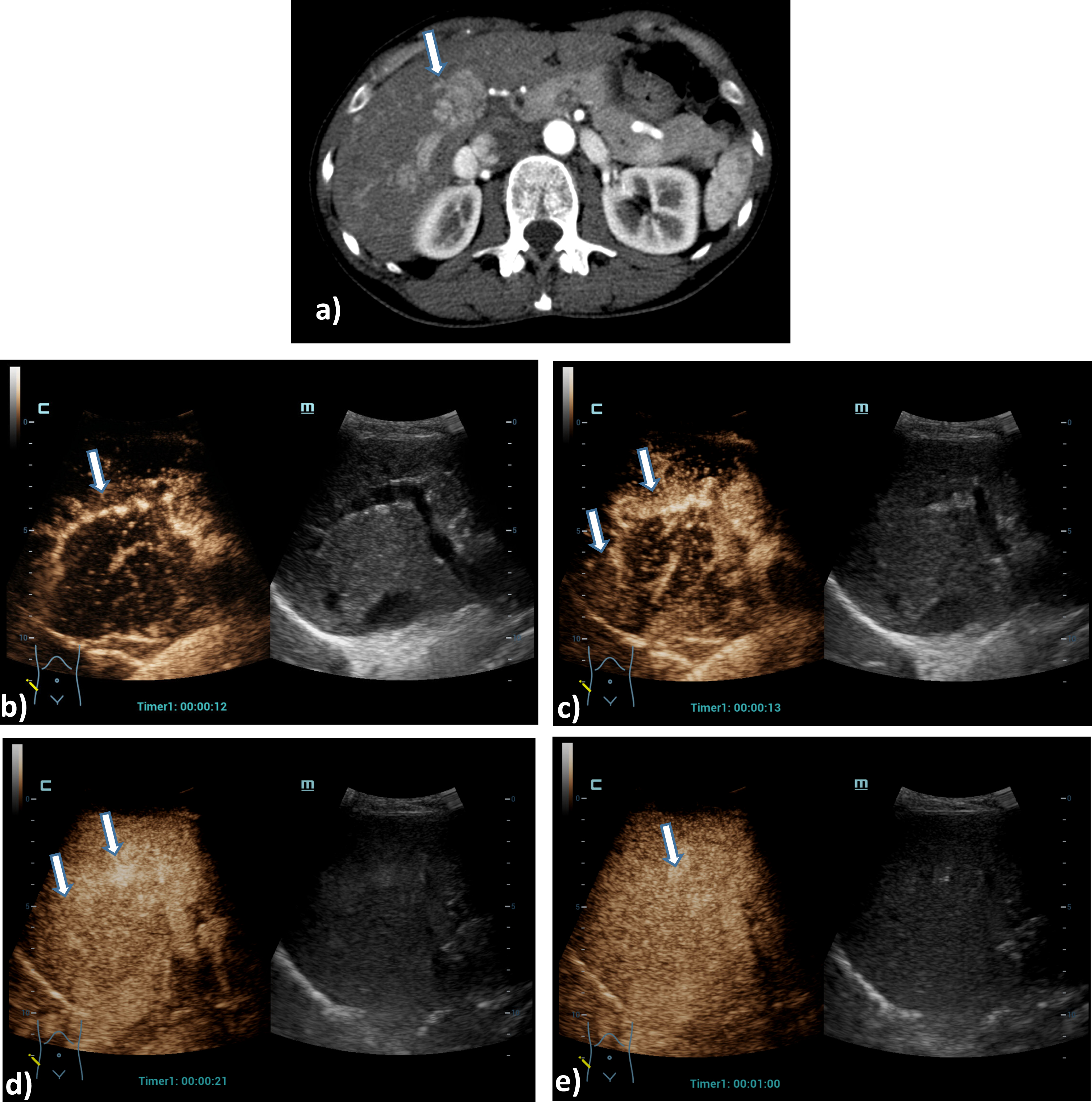 Case of a 54 years old female patient with Osler’s disease. CT scan of the lung shows irregular arterial hypervascularization of the central liver (a), after bolus injection of 1.5 ml ultrasound contrast agent HiFR-CEUS shows during early arterial phase (b), arterial phase (c), late arterial phase irregular dilatation of the hepatica artery (arrow) and hyperenhancement of hemangiomas (d). Late phase of HiFR-CEUS after 1 min shows homogenous contrast of the liver parenchyma without wash out (e).