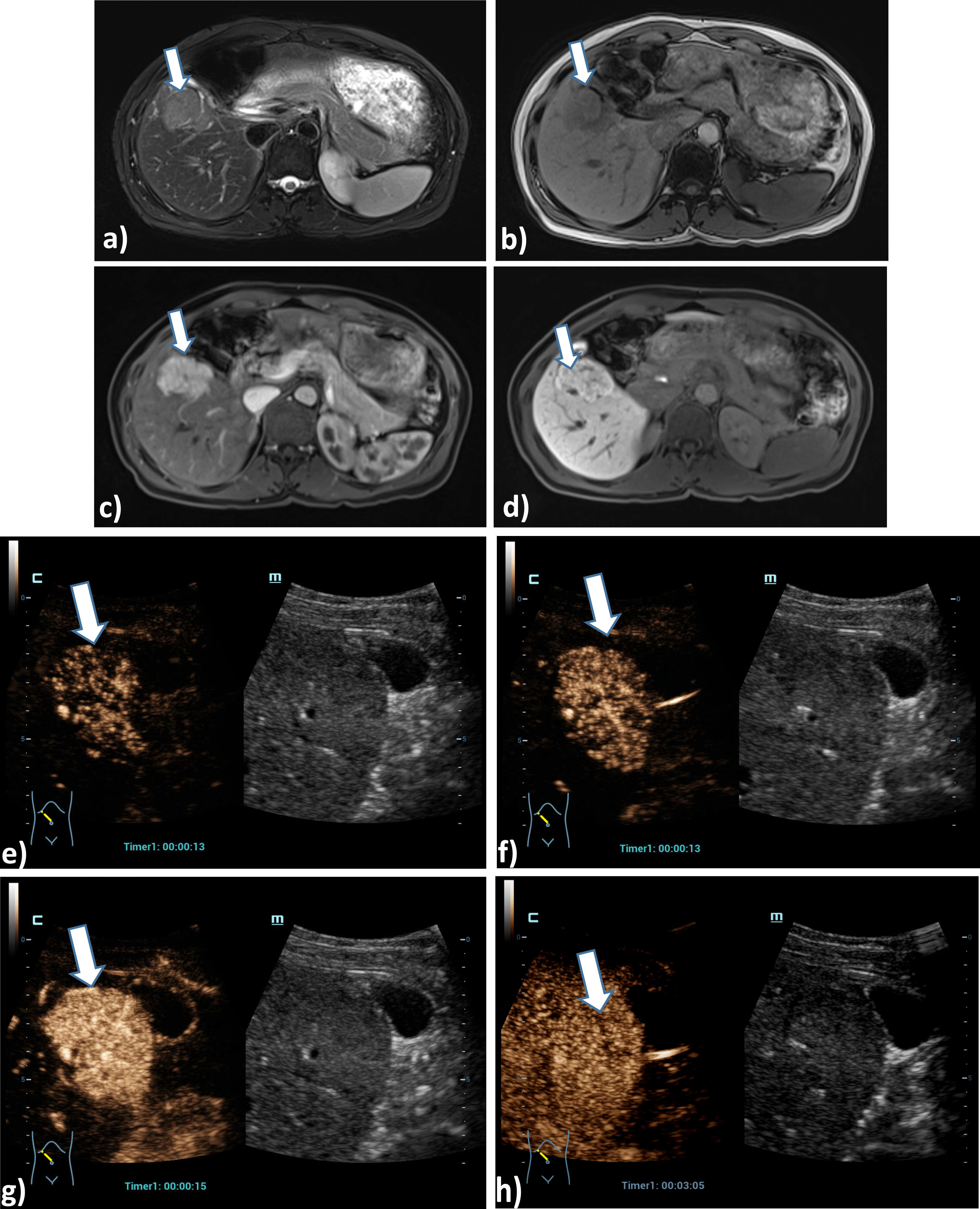 Case of a 45 years old female patient with a liver lesion on the right liver lobe, segment V, 5 cm in diameter. Correlation of the tumor lesion by MRI T2, T1, arterial phase and late contrast phase (a, b, c, d) using liver specific contrast agent as a benign lesion. Using HiFR-CEUS with bolus injection of 1.5 ml ultrasound contrast agent shows typical signs of a focal nodular hyperplasia (FNH) with contrast enhancement from the center to the margin during early arterial phase up to arterial phase (e, f, g) and no wash out after 3 min in the late phase with a small central scar (h) (arrow).