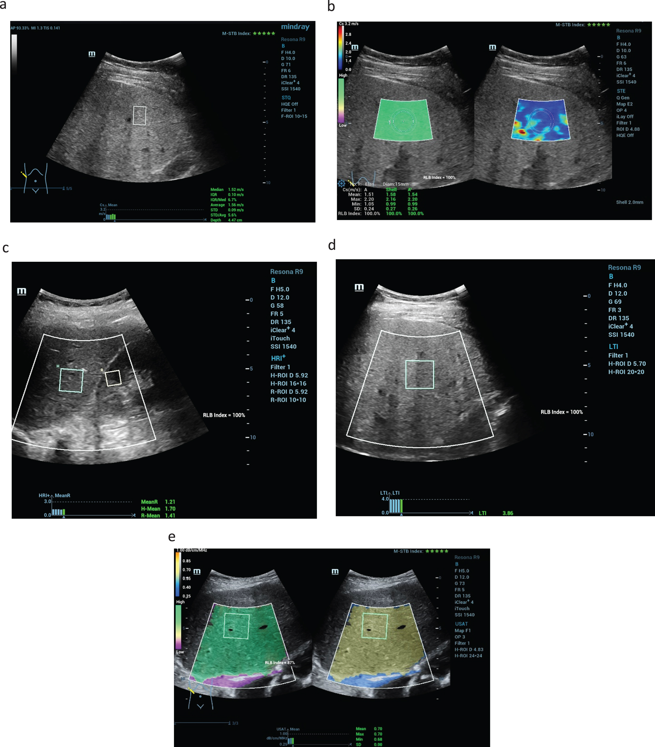 New ultrasound modalities of non-invasive evaluation of the liver stiffness in a case of F1 fibrosis up to 1.5 m/s (a), color-coded shear wave technique with high image quality (5 green stars) with blue and less yellow colors parts as a sign of less liver stiffness (b). Using the new liver tissue technologies the parenchymal comparison from kidney cortex and liver tissue is possible with values > 1,2 (HRI+) and values up to 0.7 dB/cm/MHz for the liver fatty measurements (USAT) (c). LTI measurements with values up to 3.8 after chronic inflammatory reaction (d). High image quality of 100% and 5 stars in all case (e).