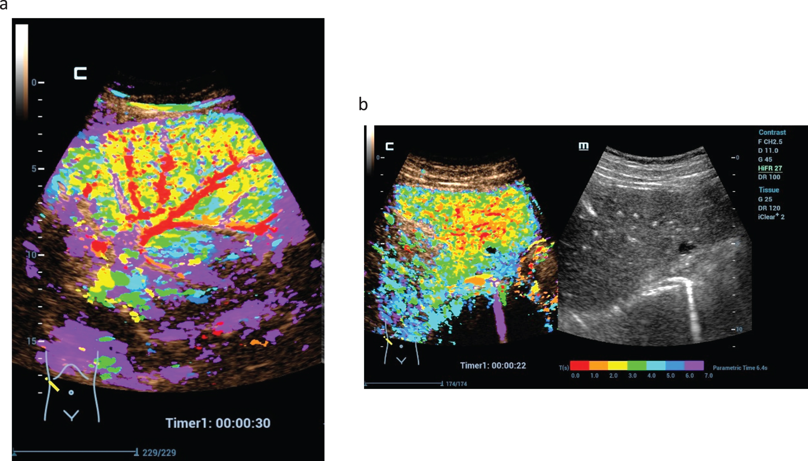 Possibilities of parametric evaluation of dynamic CEUS by false colors of dynamic arterial microvascularization of the liver. By red color detection of early enhancement of vascular structures (a) and hyperenhancement of a tumor lesion by red, orange and yellow color maps, not detectable by the fundamental B-mode (b).