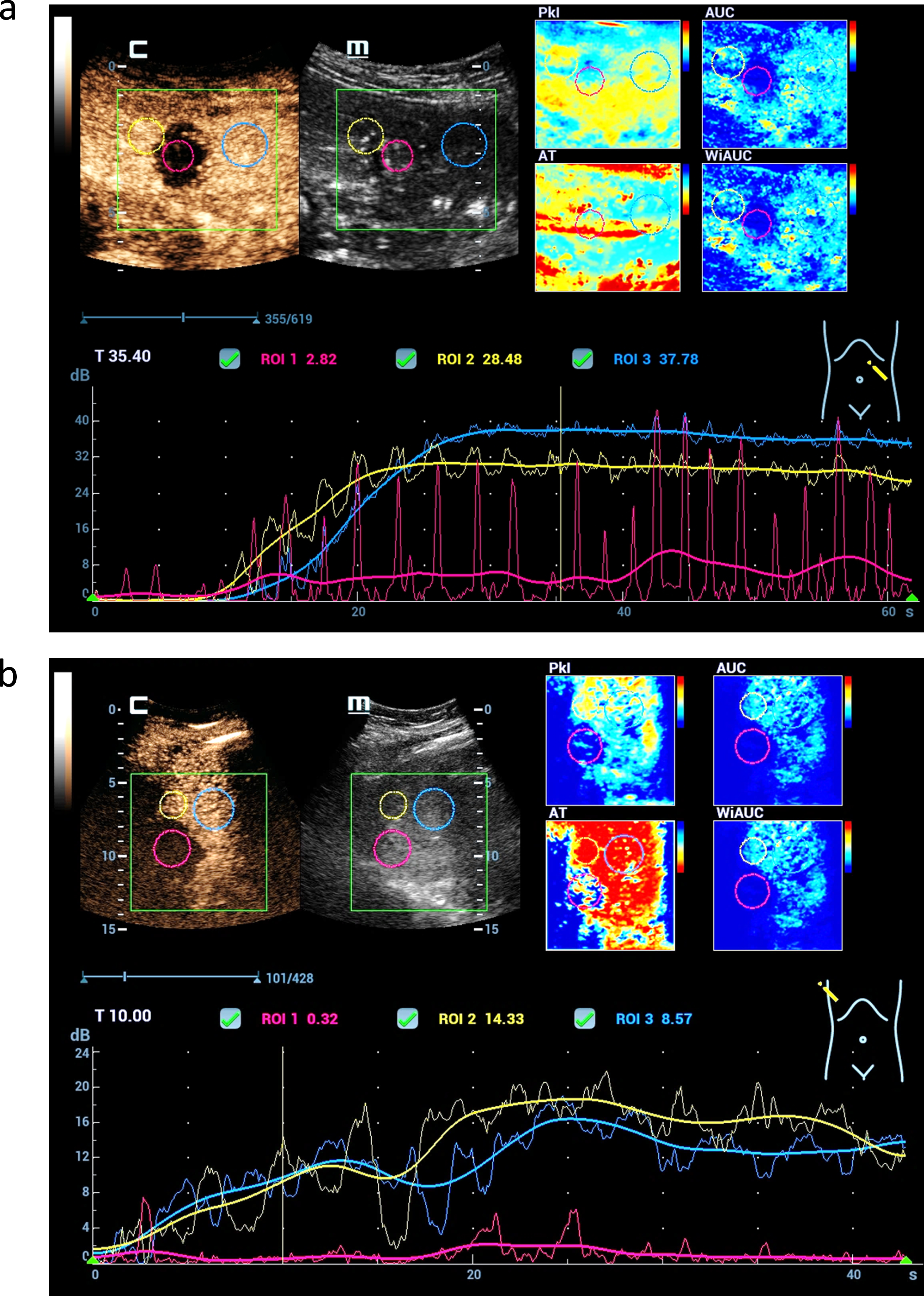 CEUS perfusion imaging after complete treatments of malignant liver lesions by microwave ablation therapy (MWA). Parametric imaging using color maps could visualize the different perfusion parameters (AUC, PKI, WiAUC, AT) (a). TIC analysis shows not relevant enhancement in the center of the MWA defect (red) and continuous enhancement of the margin (yellow) and the liver tissue (blue) (b).