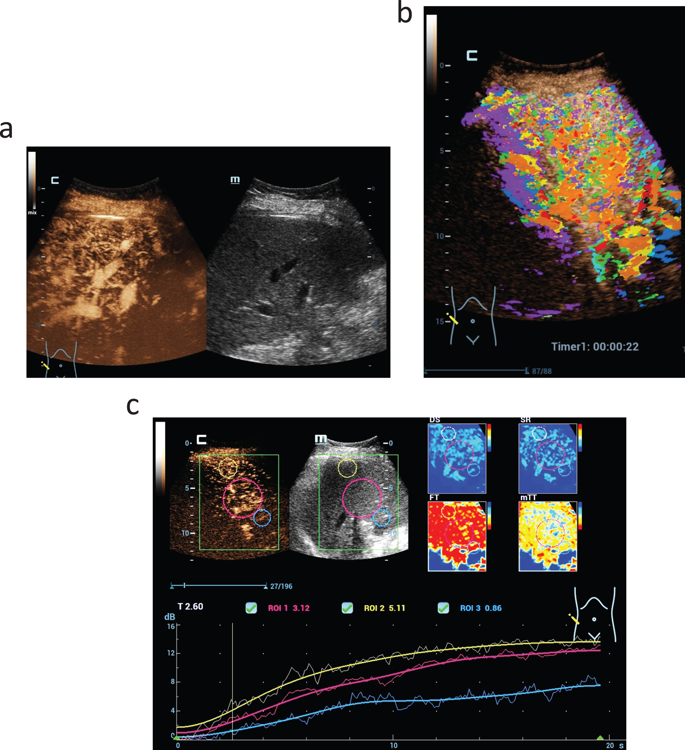 High resolution CEUS, parametric color coded imaging and CEUS perfusion imaging (a) with color maps of different perfusion parameters (DS, SR, FIT, mTT) and time intensity curve in a case of Osler's disease (b). Dynamic evaluation of the capillary microvascularization shows capillary shunts with early enhancement after 12 s, short mean transit time (MTT) and strongly global enhancement evaluated by the time-intensity-curve (TIC) (c).