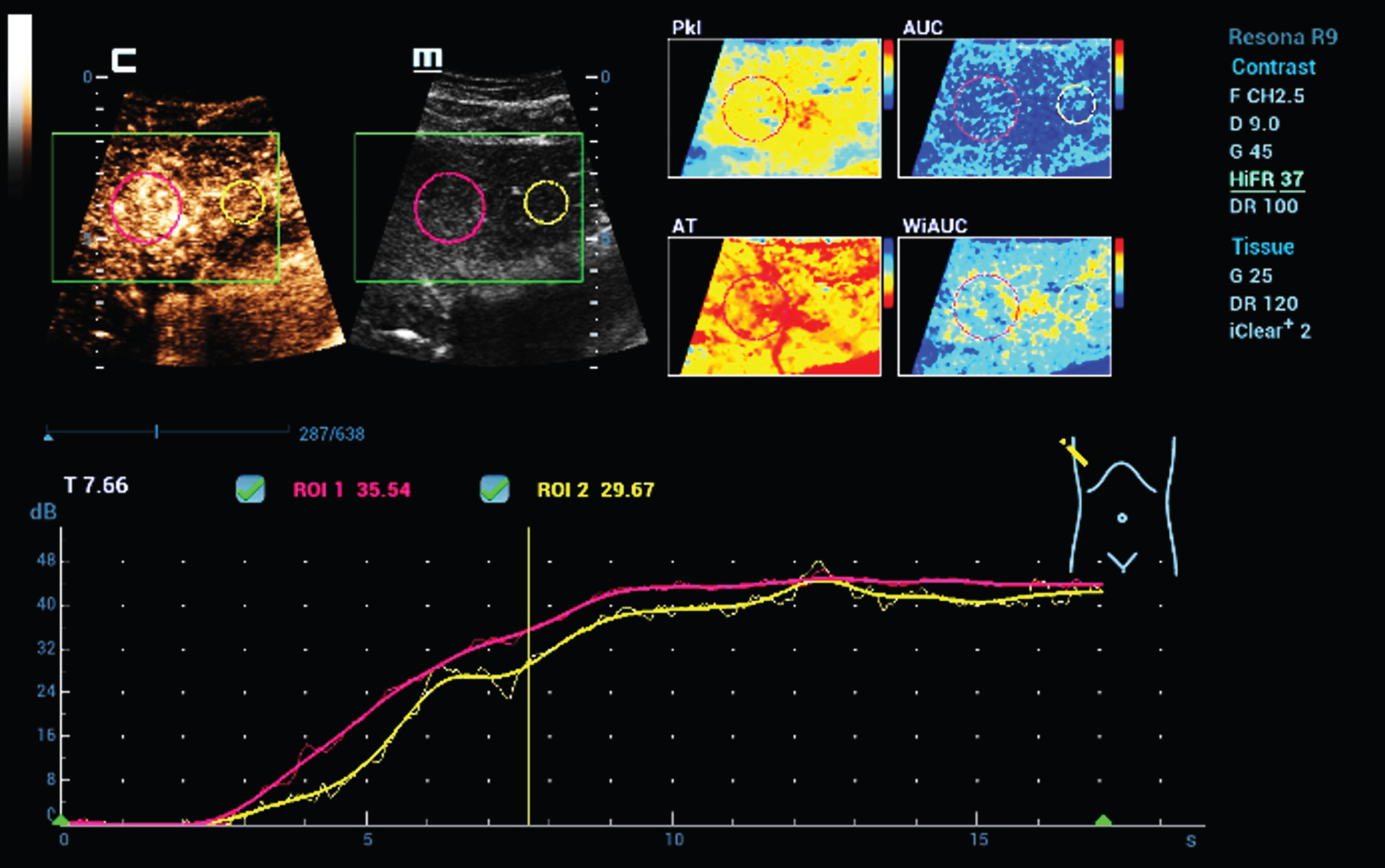Color coded parametric and time intensity curve analysis (TIC) of dynamic microvascularization of a benign liver lesion using HiFR CEUS. Typical for a focal nodular hyperplasia (FNH) is the continuous enhancement for the center to the margin with than similar contrast like the live tissue. Color maps could visualize different perfusion parameters (AUC, PKI, WiAUC, AT).