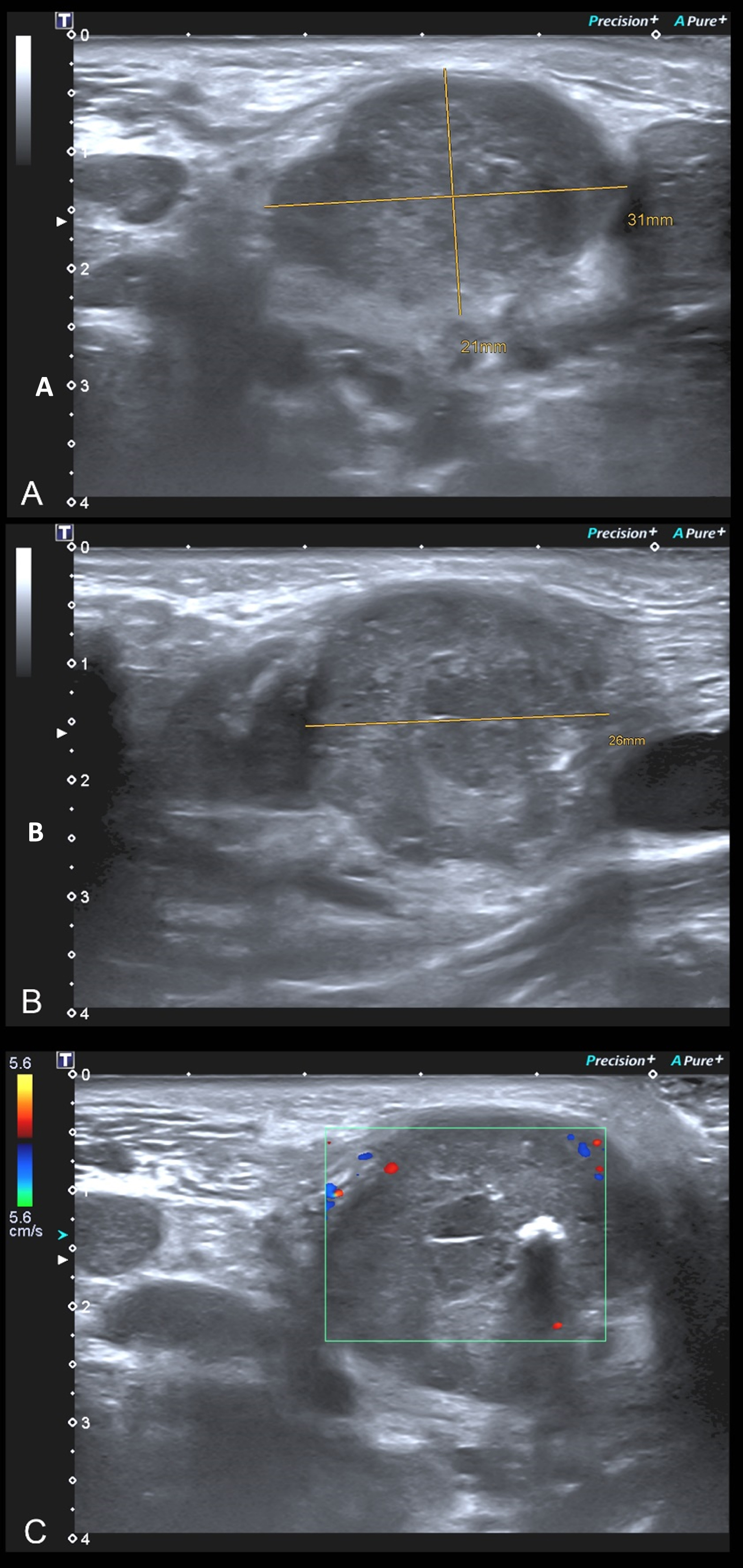 B-Mode Sonography (A, B) and Doppler-Sonography (C), performed to identify and safely evaluate the lesion intended to be biopsied with US-CNB.
