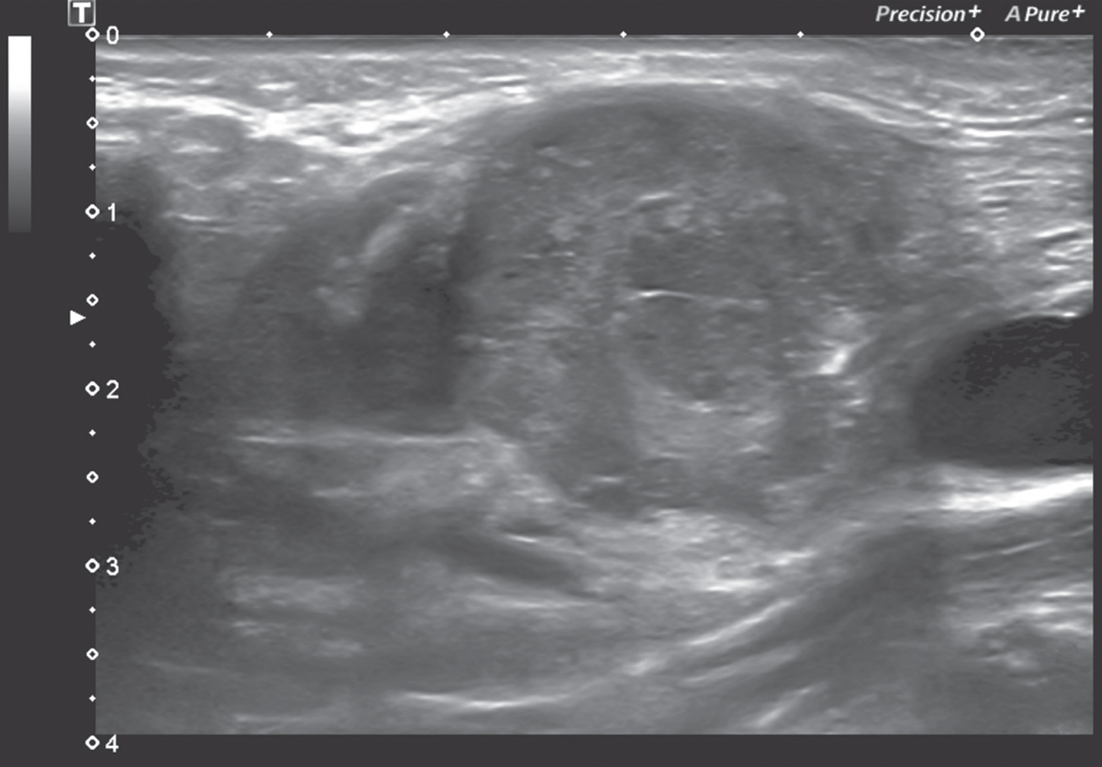 US control of the biopsied lesion is performed to rule out potential bleeding in B-Mode sonography.