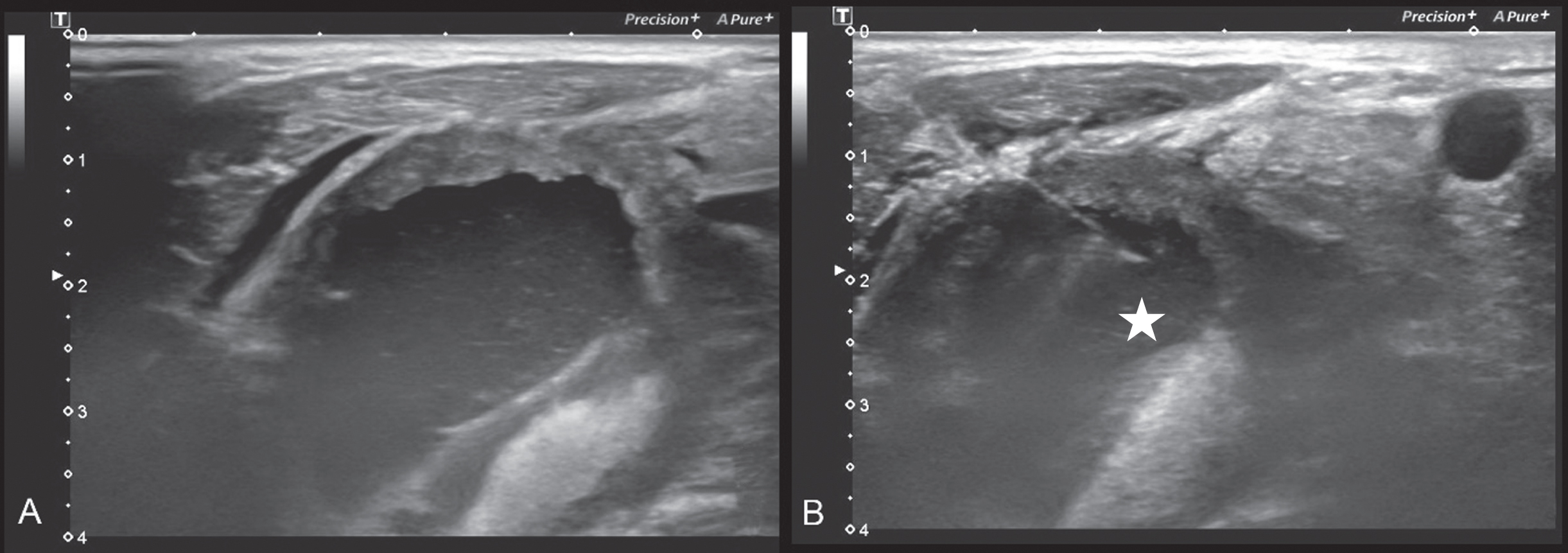 Images of a 66-years old patient with a large partial cystic lymph node metastasis on the right side in whom a US-CNB of the lesion was performed and a major bleeding occurred afterwards. Fig. 4 A and B demonstrate the B-Mode sonography of the lesion with the US-CNB placement in the solid rim of the lesion (marked with a white star (*)).