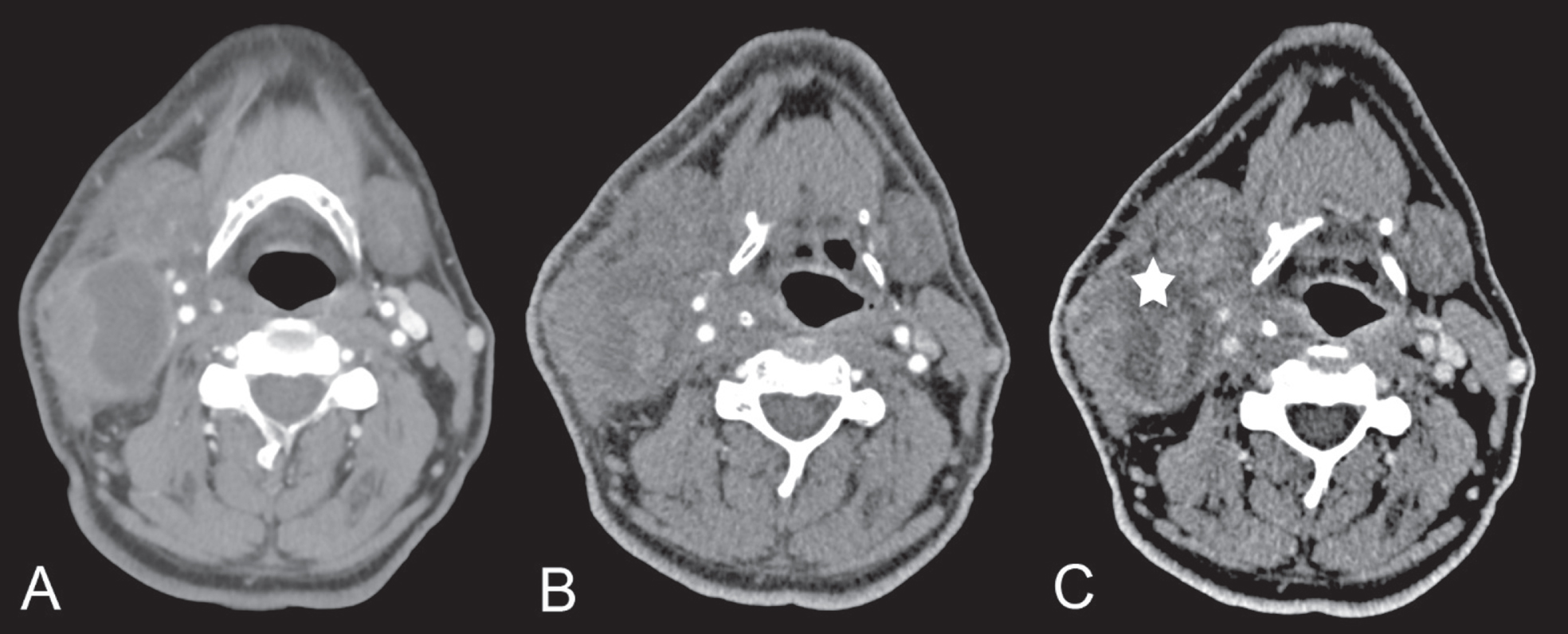 A shows the lesion in CT before the US-CNB and Fig. 5 B and C represent the CT in arterial (B) and venous phase (C) which was performed after the US-CNB to potentially detect the bleeding site (but no acute bleeding was detected) and to document the hematoma size (*) within the cystic part of the metastatic lymph node.