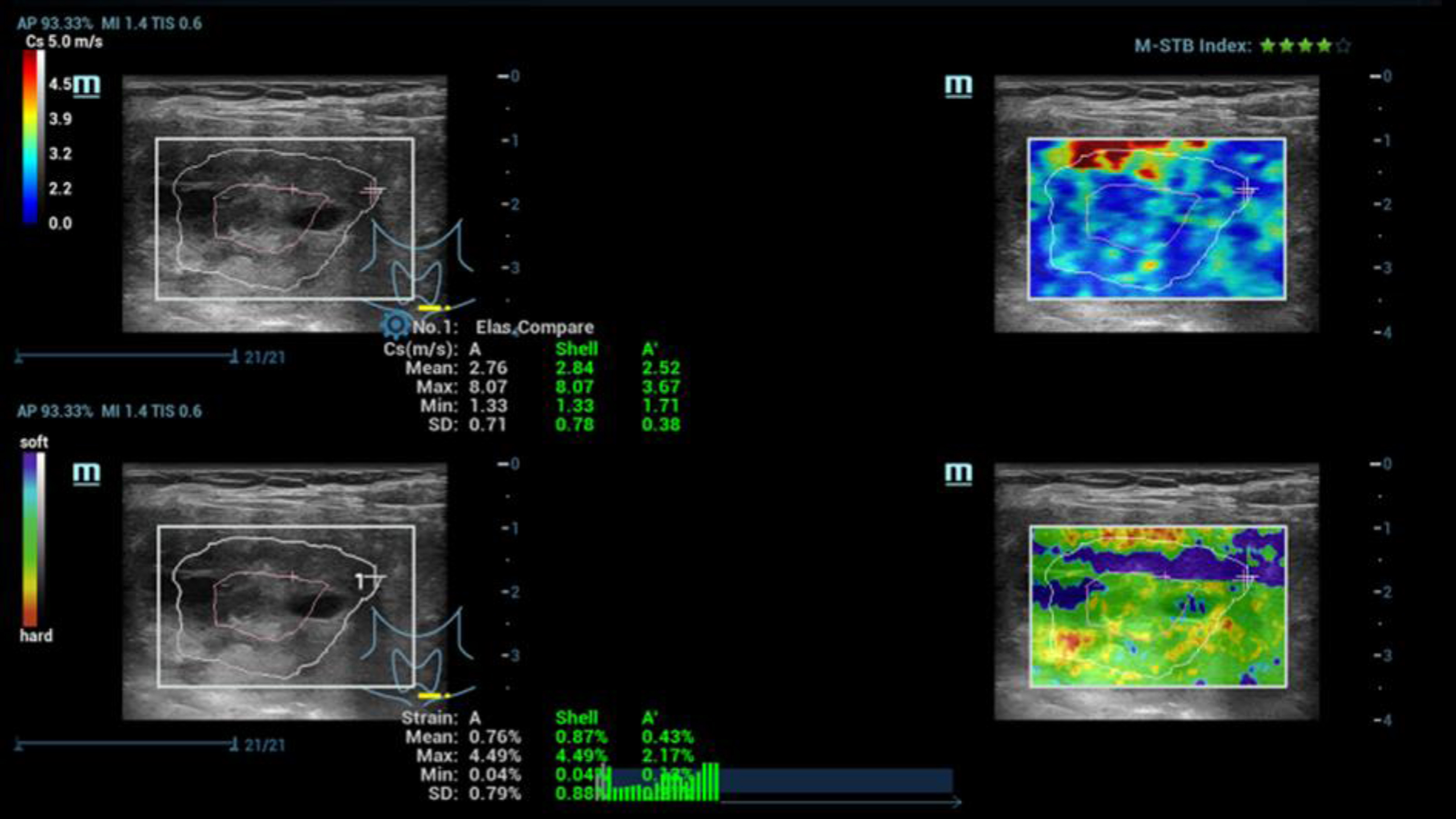 Ultrasound elastography, simultaneous evaluation by strain and shear wave elastography of a suspicious malignant thyroid tumor (TI-RADS IV). Lower stiffness of the center (blue) and irregular higher stiffness at the margin (yellow and red) with values up to 2.5 m/s.