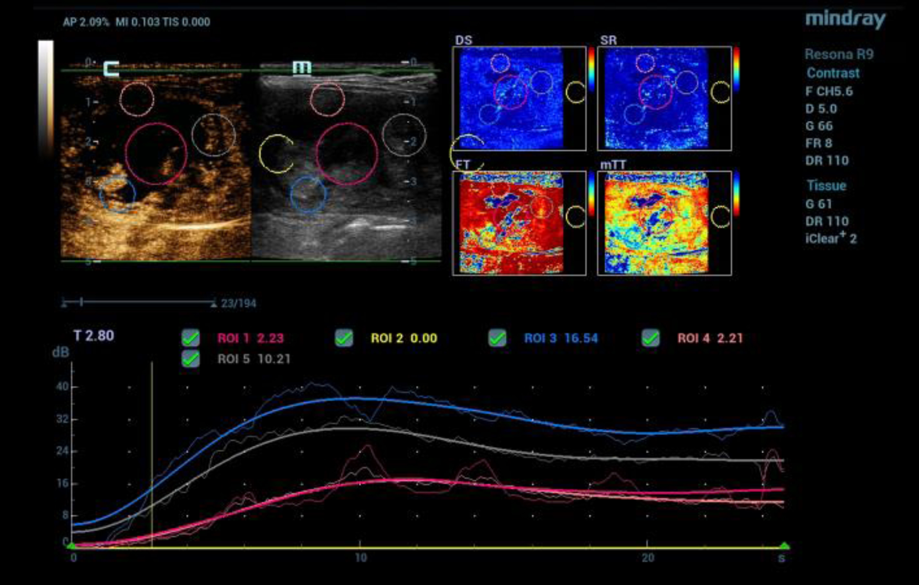 CEUS after bolus injection of 1.5 ml contrast agent (SonoVue®) with irregular microvascularization of a malignant thyroid tumor (TI-RADS V). Color coded perfusion imaging with evaluation of different perfusion parameters (PKI, AT, AUC, WiAUC). Dynamic detection of the tumor microvascularization using time intensity curve (TIC) evaluation from the early arterial phase after 15 sec up to 1 minute.