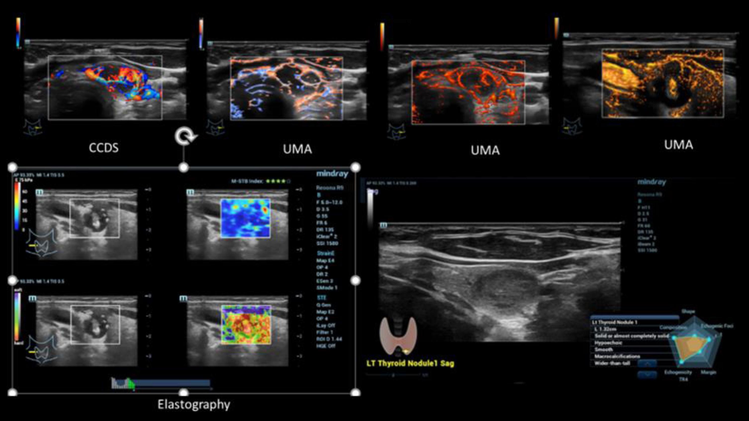 Case of a small intracystic papillary thyroid cancer (TI-RADS IV). Irregular vascularization detected by CCDS and UMA in different color modalities (upper line). Irregular stiffness detected by simultaneous mode of strain and shear wave elastography (left down). Characterization by B-Mode criteria using AI (right down).