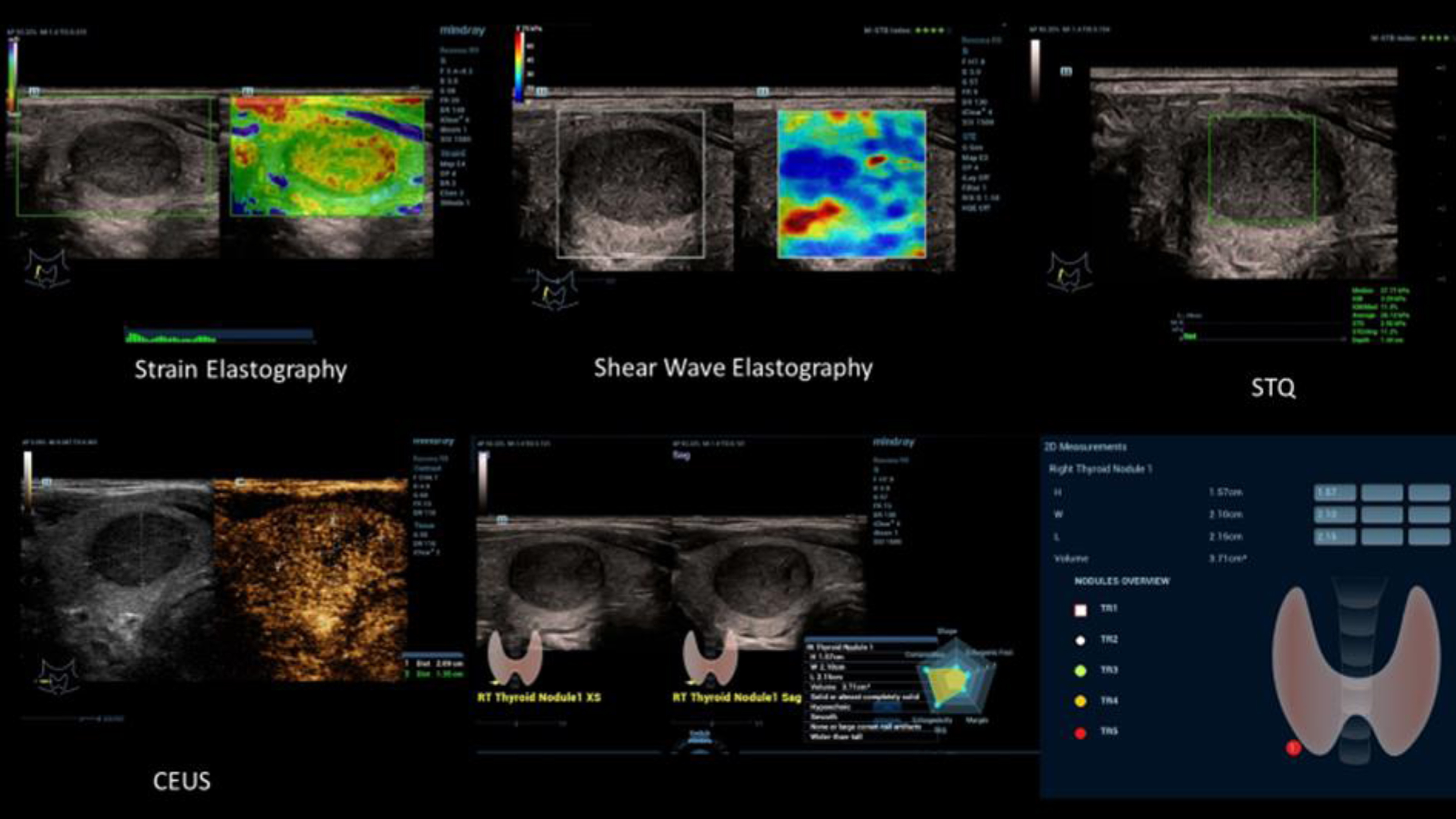 Multimodality ultrasound diagnosis of medullary thyroid carcinoma (TI-RADS V) with inhomogeneous compaction in strain and shear wave elastography (top left), with irregular micro-vascularization with CEUS (top right, bottom left) and documentation and evaluation with AI tools bottom right.