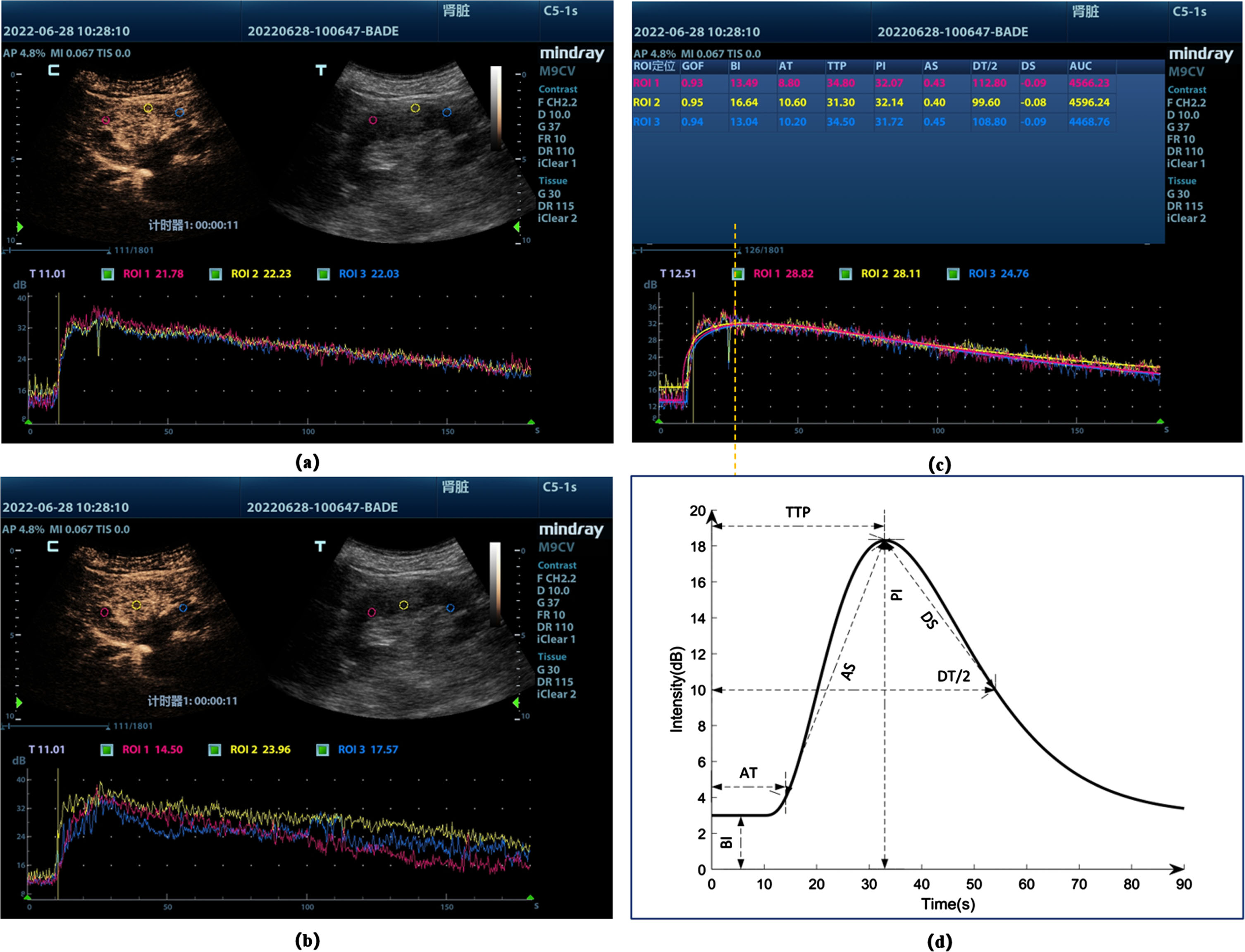 Time-intensity profiles of different sites (a) Cortical sampling site and TIC, the screen shows the contrast-enhanced image (C) As well as the conventional ultrasound image (T); (b) Medullary sampling site and TIC; (c) Plotting of regions of interest (ROIs) analyzed by the software, and then generating the supply curves for each ROI (lower section), these curves represent intensity as a function of time. (d) Schematic diagram of ultrasonography parameters. BI, basic intensity; AT, arrival time; TTP, time to peak; AS, ascending slope; DT/2, descending time/2; DS, descending slope; PI, peak intensity; AUC, area under the curve.