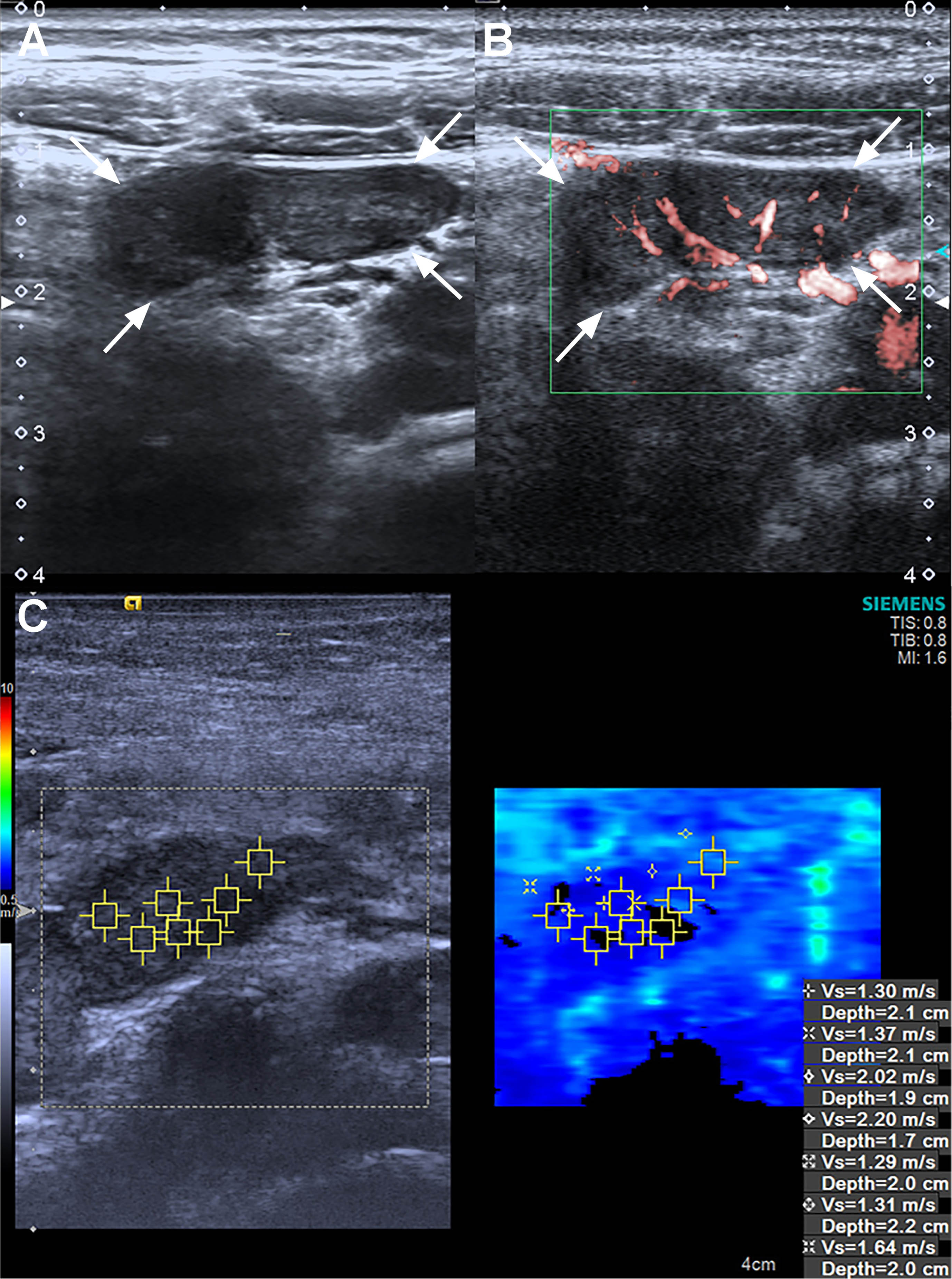 Ultrasound, superb microvascular imaging and Virtual Touch imaging and quantification of a 7 years old pediatric male patient in the mesenteric lymphadenitis group. (A) B-Mode ultrasound reveals it is a L/S <1 lymph node. (B) Superb microvascular imaging reveals it is an Adler G3 node. (C) Virtual Touch imaging quantification reveals the SWVMax, SWVMin, and SWVMean of the node is 2.20 m/s, 1.29 m/s, and 1.59 m/s. SWVMax = maximum shear-wave velocity, SWVMin = minimum shear-wave velocity, and SWVMean = average shear-wave velocity.