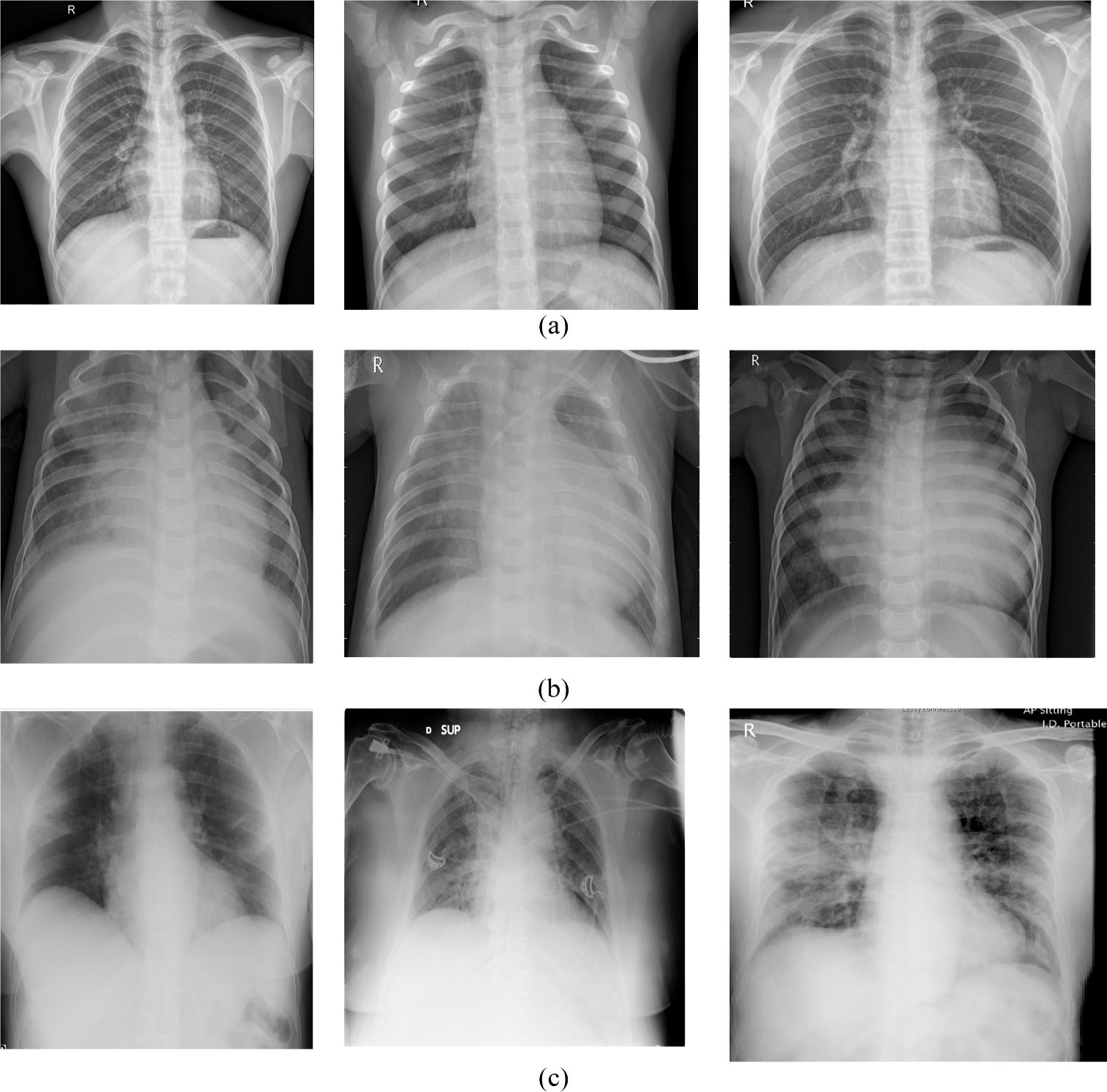 Example of the (a) normal, (b) pneumonia, and (c) COVID-19 experimental X-ray images [65].