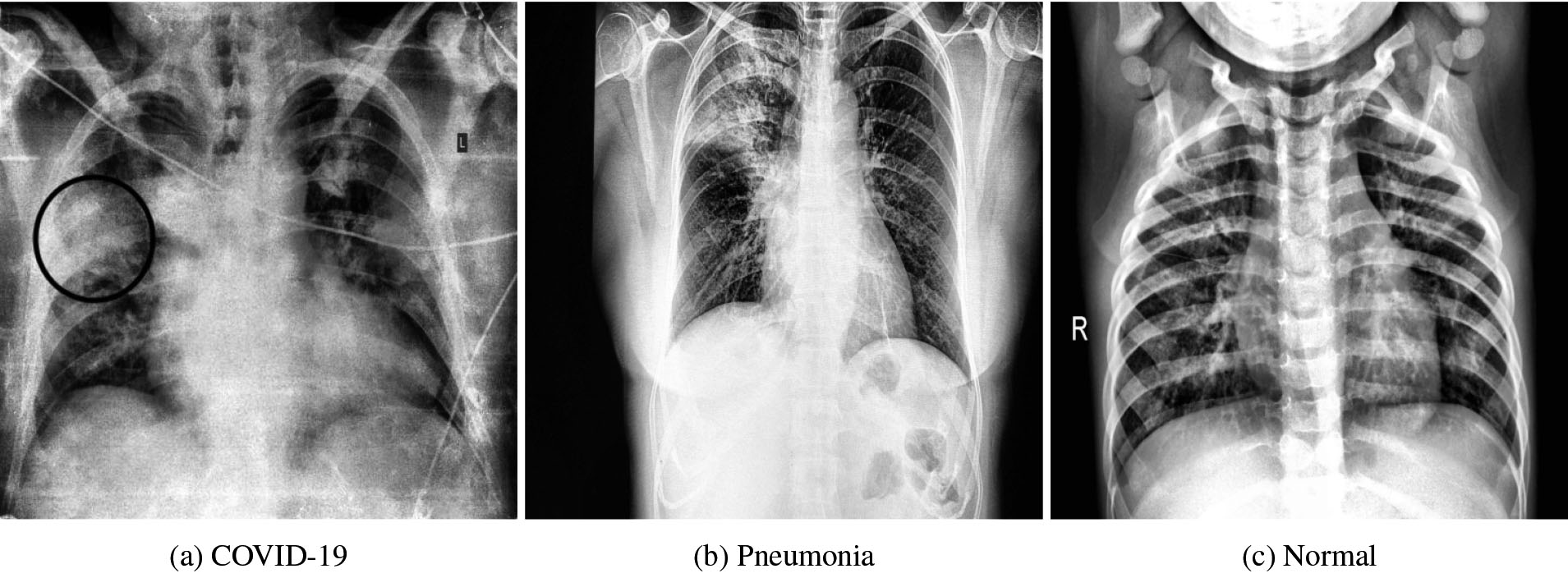 Manually annotated CXR images highlighting the regions of interest that distinguishes between COVID-19 and pneumonia cases. The above regions are marked by a radiologist after clinical evaluation of these CXR images.