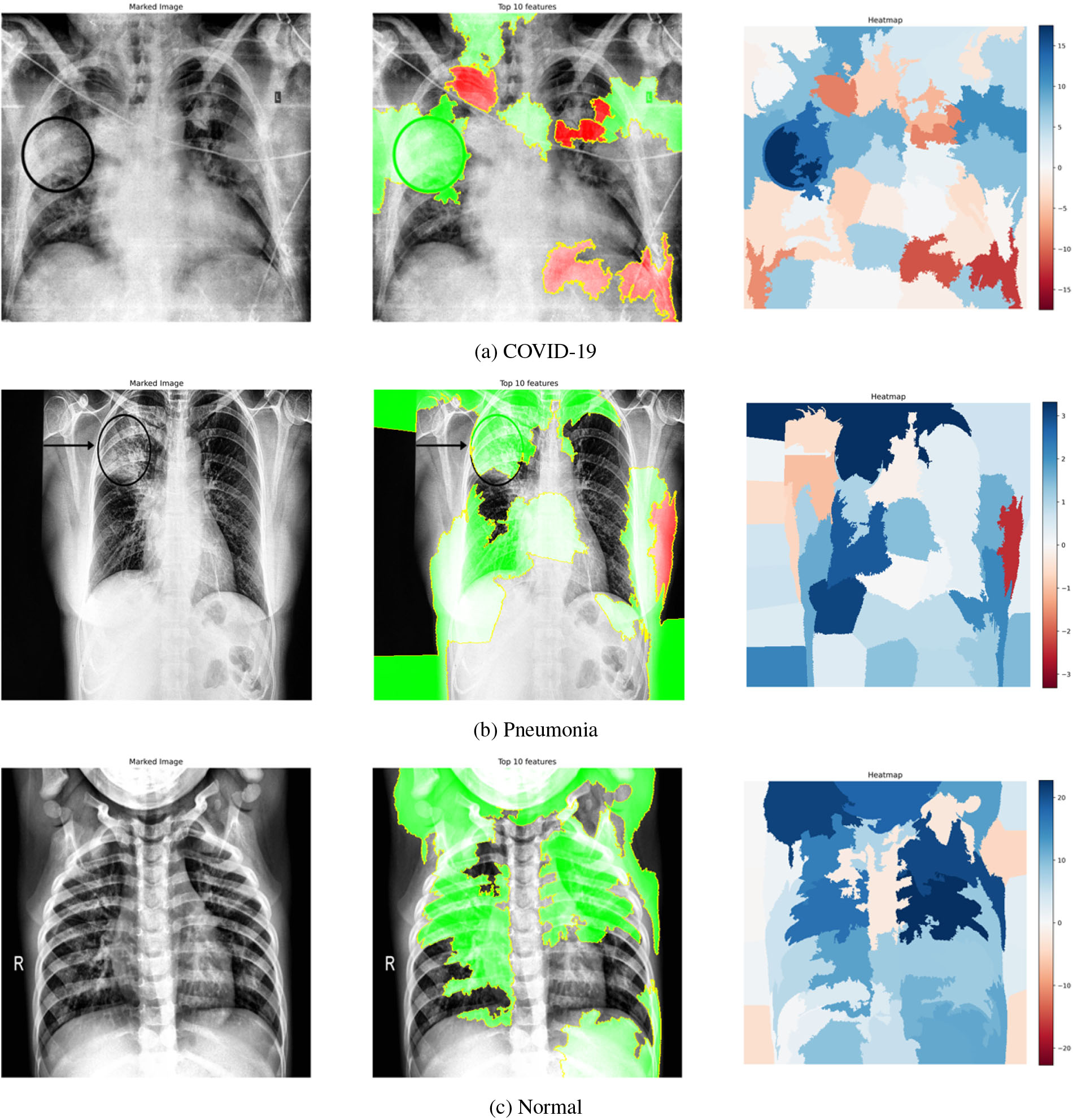 (a)–(c) corresponding to COVID-19, Pneumonia, normal cases, respectively. In each row – the first CXR image depicts the clinically evaluated and manually marked regions, second CXR image highlights the top 10 superpixels obtained using LIME, and the third image is the LIME generated heatmap corresponding to the second image.