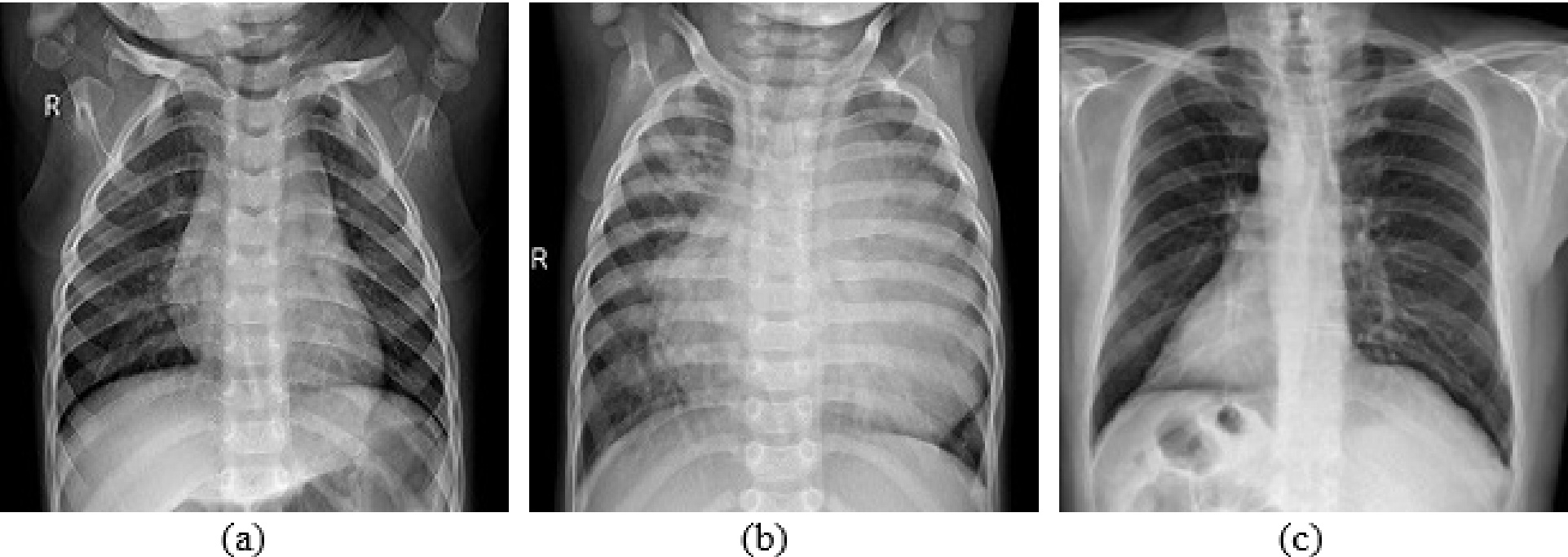 X-ray image types a) healthy b) non-COVID pneumonia c) COVID-19.