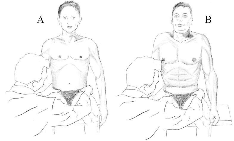 Intra-abdominal pressure regulation test. A. Optimal pattern. Proportional tensing of abdominal wall in all sections. B. Pathological stereotype. Inability to expand lower abdominal wall, asymmetrical activation, overactivity of upper rectus abdominis muscle, ribcage elevation.