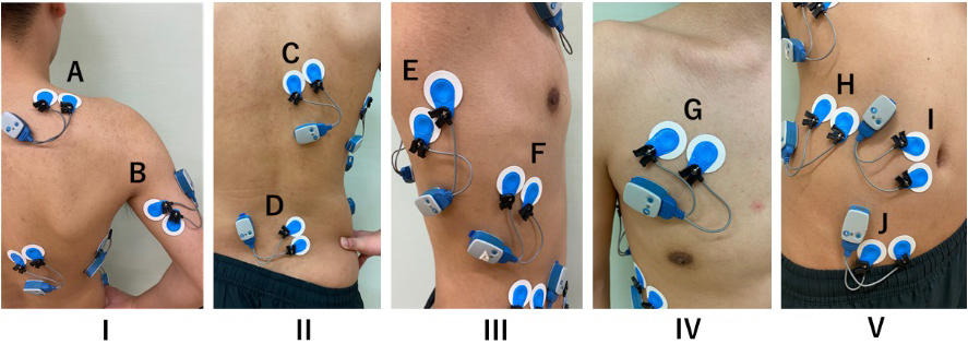 The electrode application site for electromyography. I, posterior view of the upper back; II, posterior view of the lower back; III, lateral view; IV, frontal view of the chest; V, frontal view of the abdomen; A, upper trapezius; B, medial head of the triceps brachii; C, lower trapezius; D, multifidus; E, latissimus dorsi; F, serratus anterior; G, clavicular part of pectorals major; H, external oblique; I, rectus abdominis; J, internal oblique.