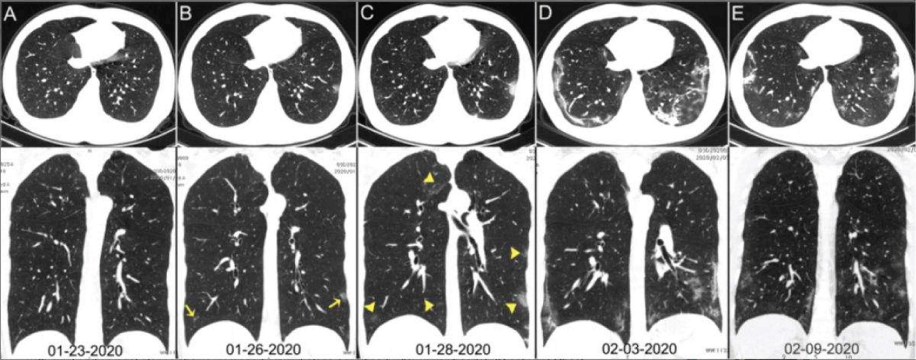 Chest CT images of infected person with coronavirus.Source: https://www.itnonline.com/sites/itnonline/files/styles/content-large.