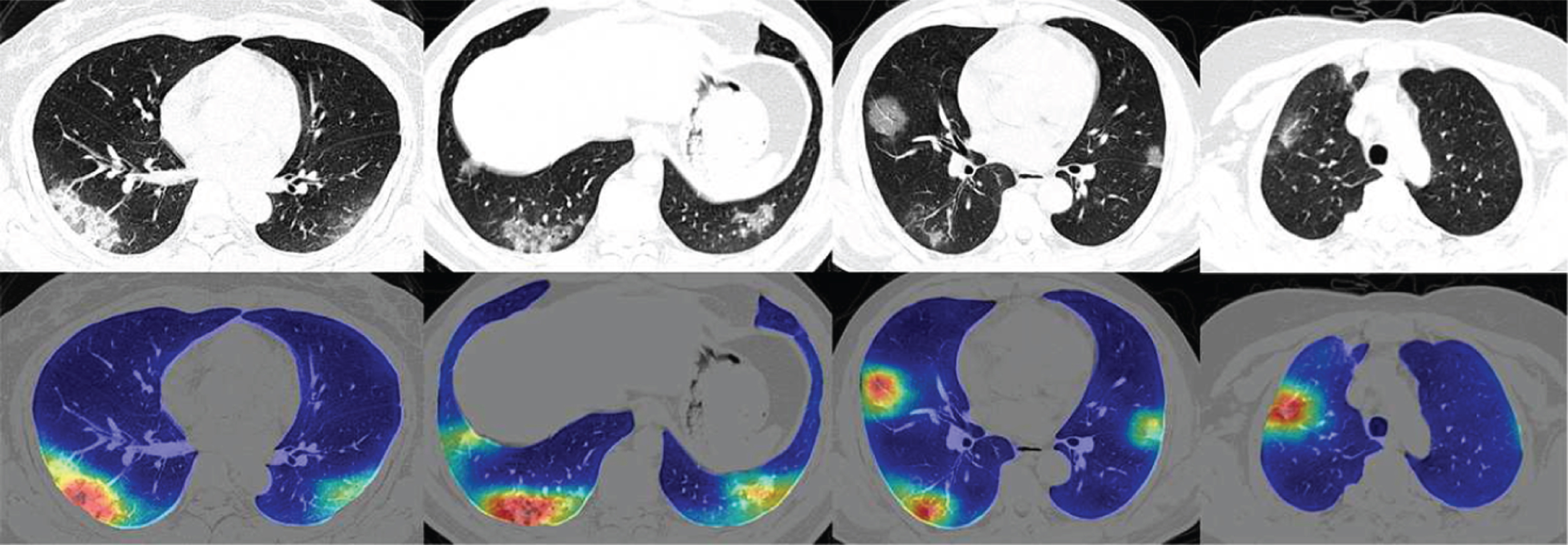 Four COVID-19 lung CT scans (top) with corresponding colored maps showing coronavirus abnormalities (bottom). Source:hospitals-deploy-ai-tools-detect-covid19-chest-scans.