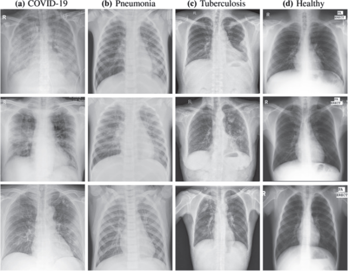 Sample examples from COVID-19 X-ray image dataset. (a) COVID-19 infected (b) Pneumonia infected (c) Bacterial pneumonia infected (d) Healthy. [40].
