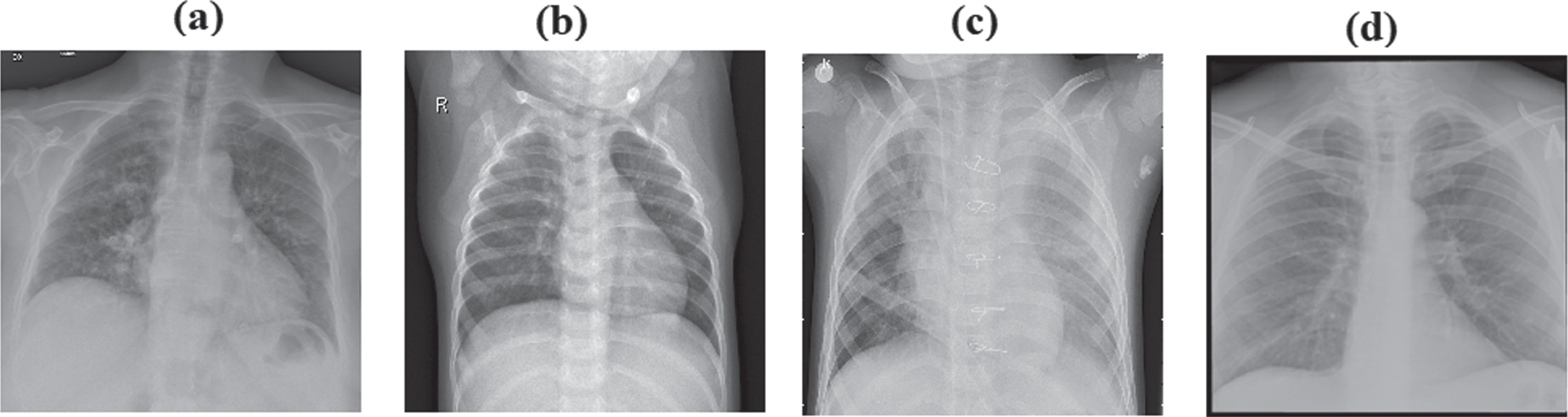 Samples from dataset a) Covid-19 (b) Normal (c) Pneumonia (d) Tuberculosis.